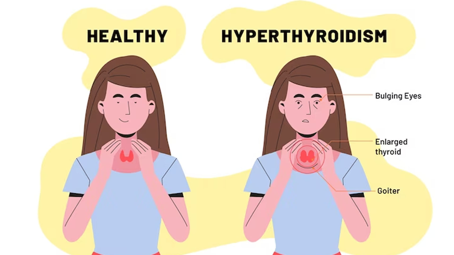 What are the Home Remedies for Hyperthyroidism?