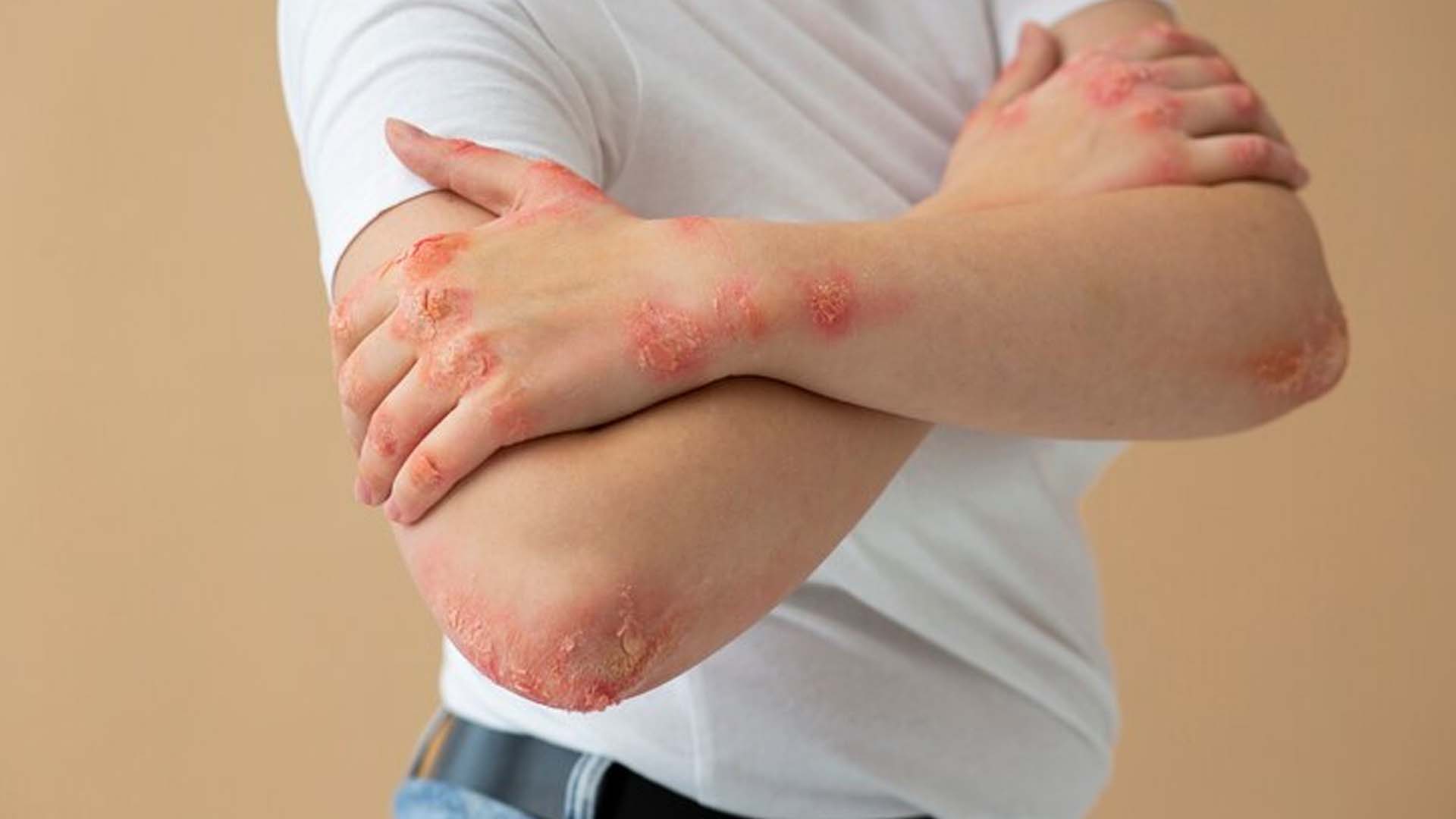 What are the Home Remedies for Keratosis Pilaris?