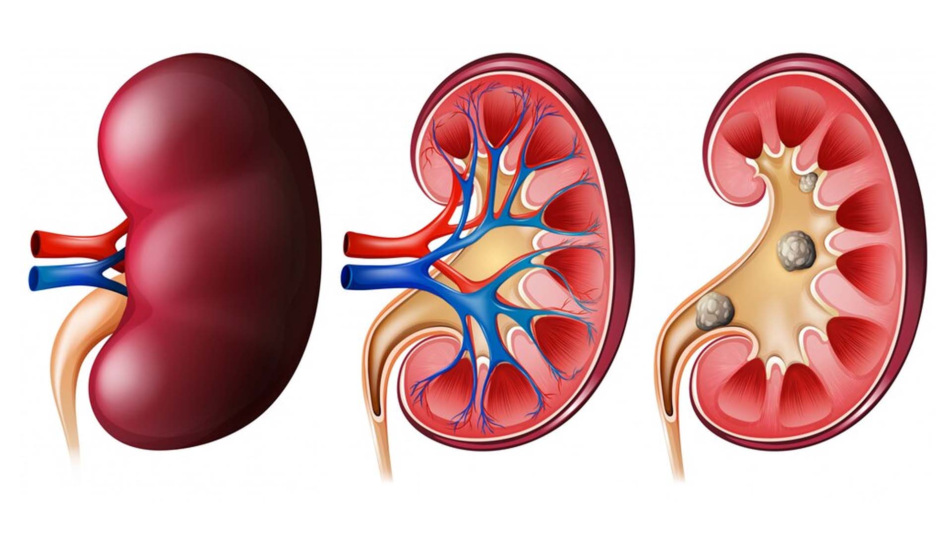 Kidney Stones