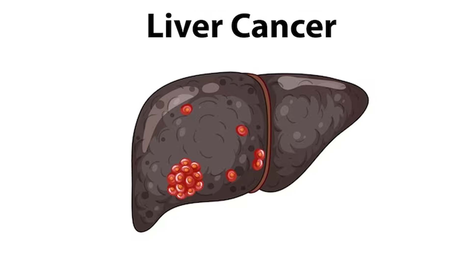 Liver Cancer