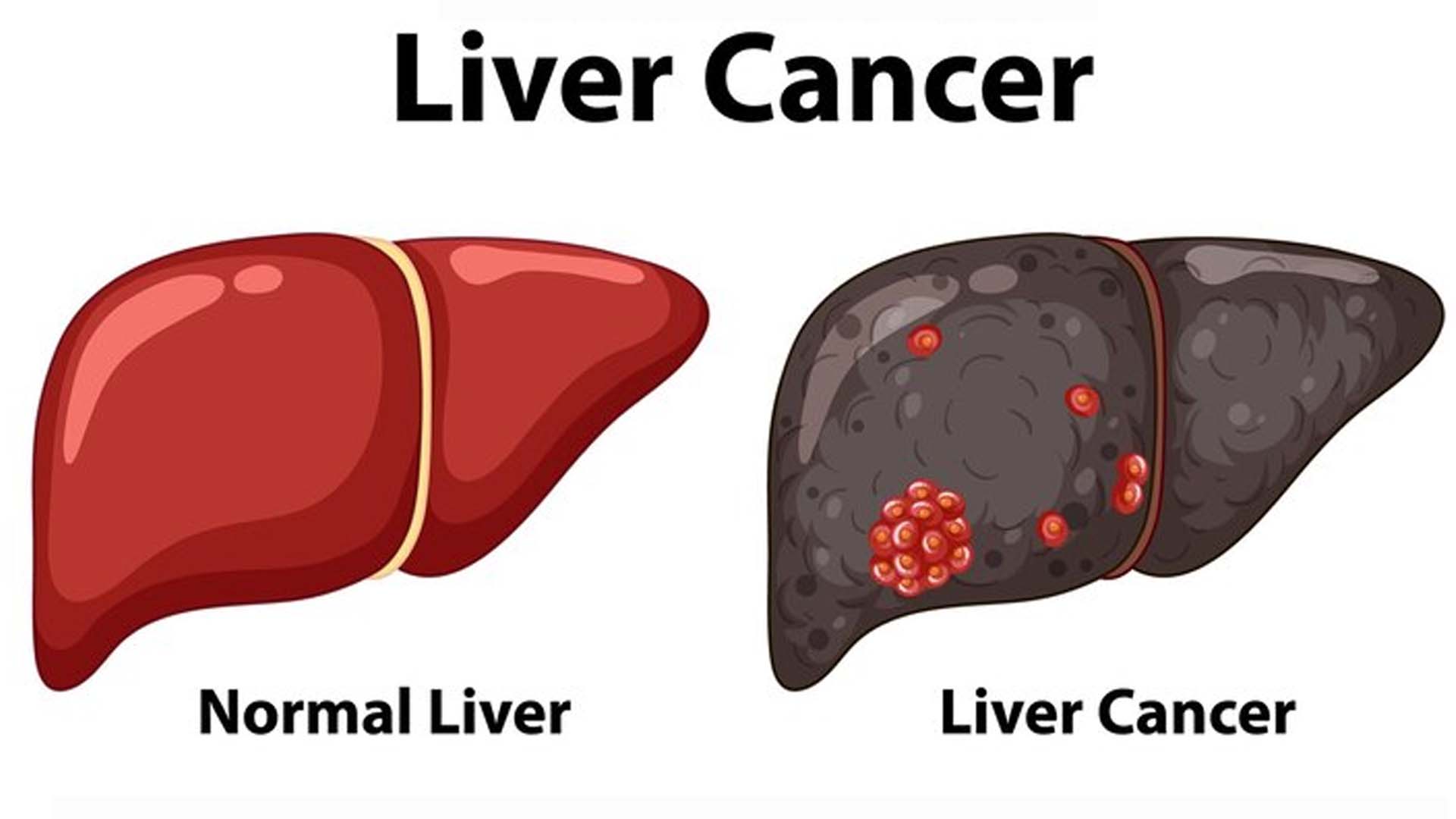Liver Cancer or hepatocellular carcinoma (HCC)
