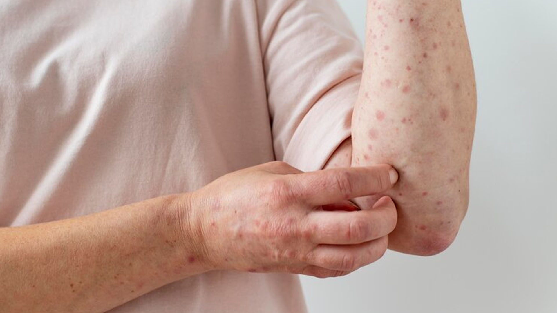 What are the Home Remedies for Measles?
