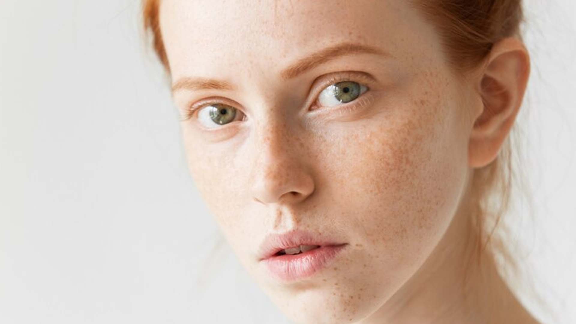 What are the Home Remedies for Melasma on Face?