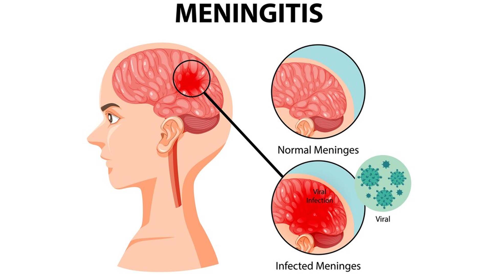 Meningitis