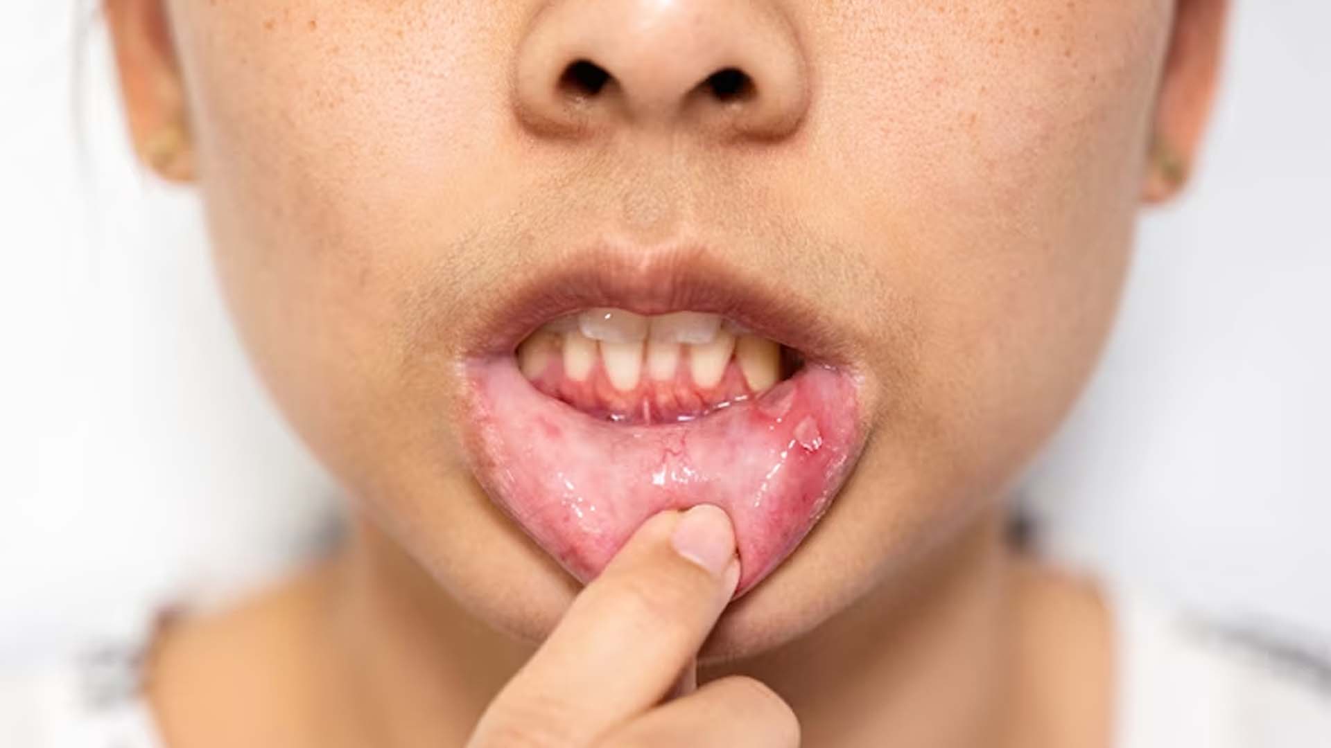 Mouth Ulcers