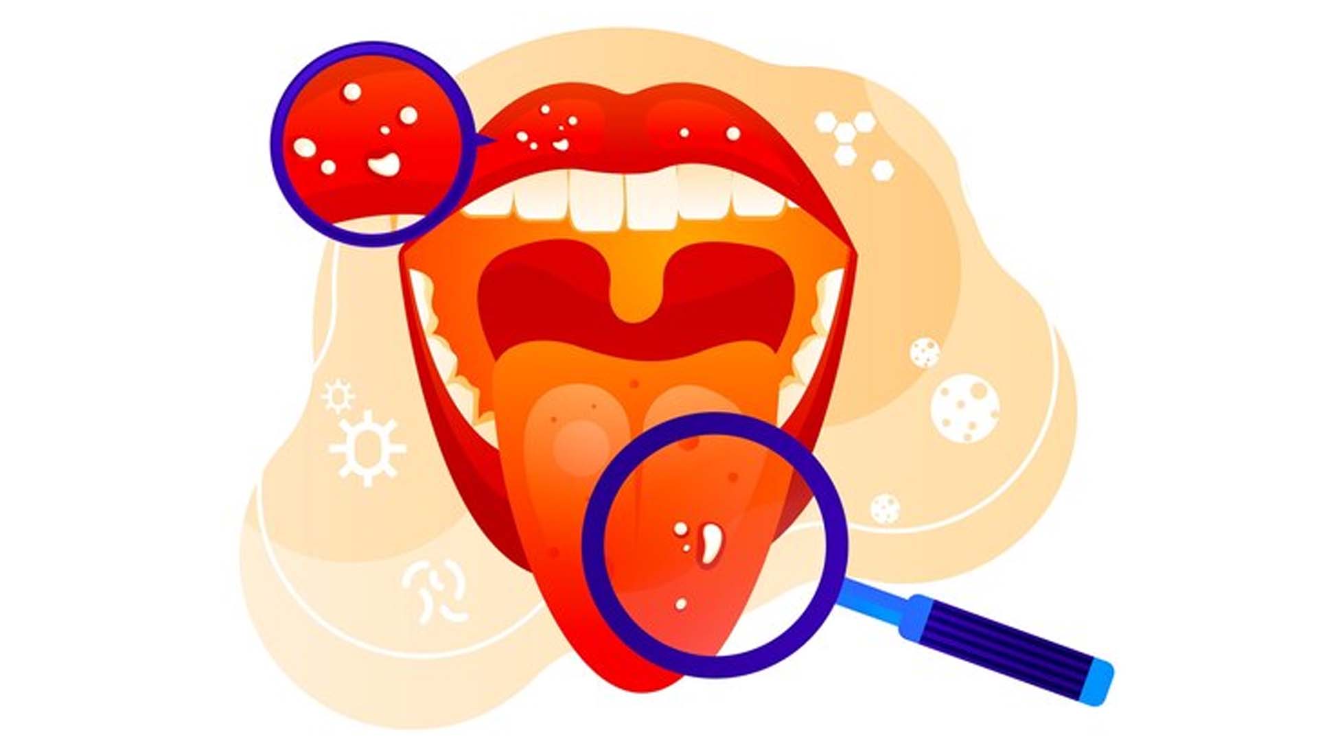 What are the Home Remedies of Mouth Ulcer on Tongue?