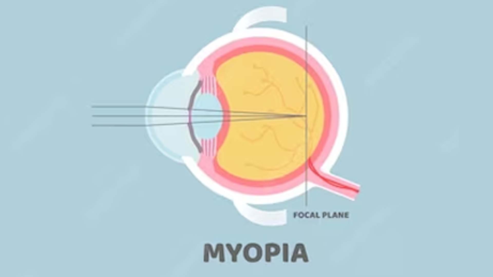 Myopia