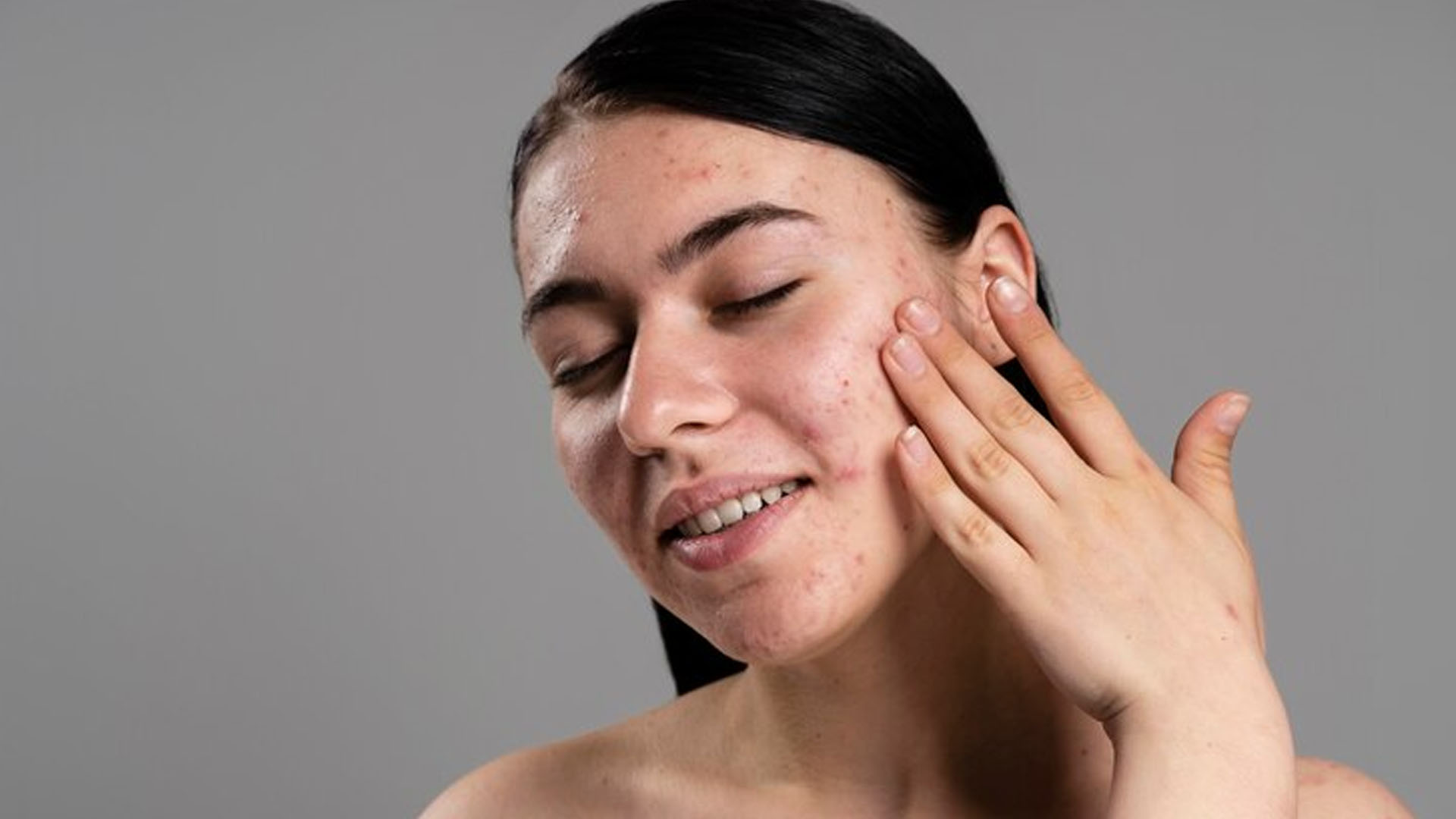 What are the Home Remedies for Oily Skin?