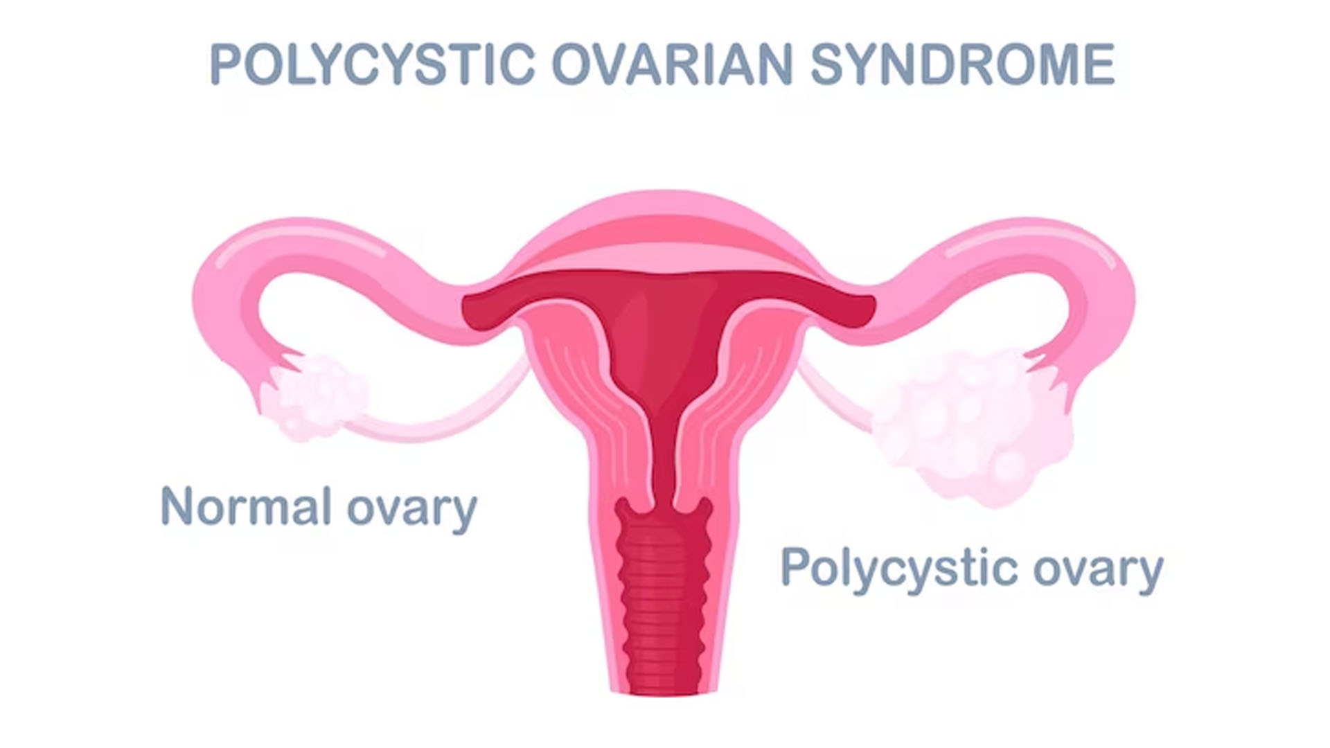 What are the Home Remedies to treat PCOS?