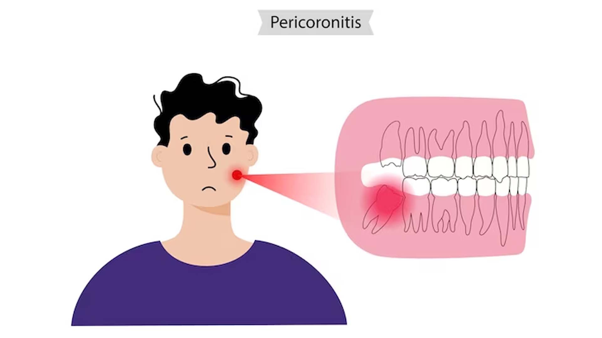 What are the Home Remedies for Pericoronitis?