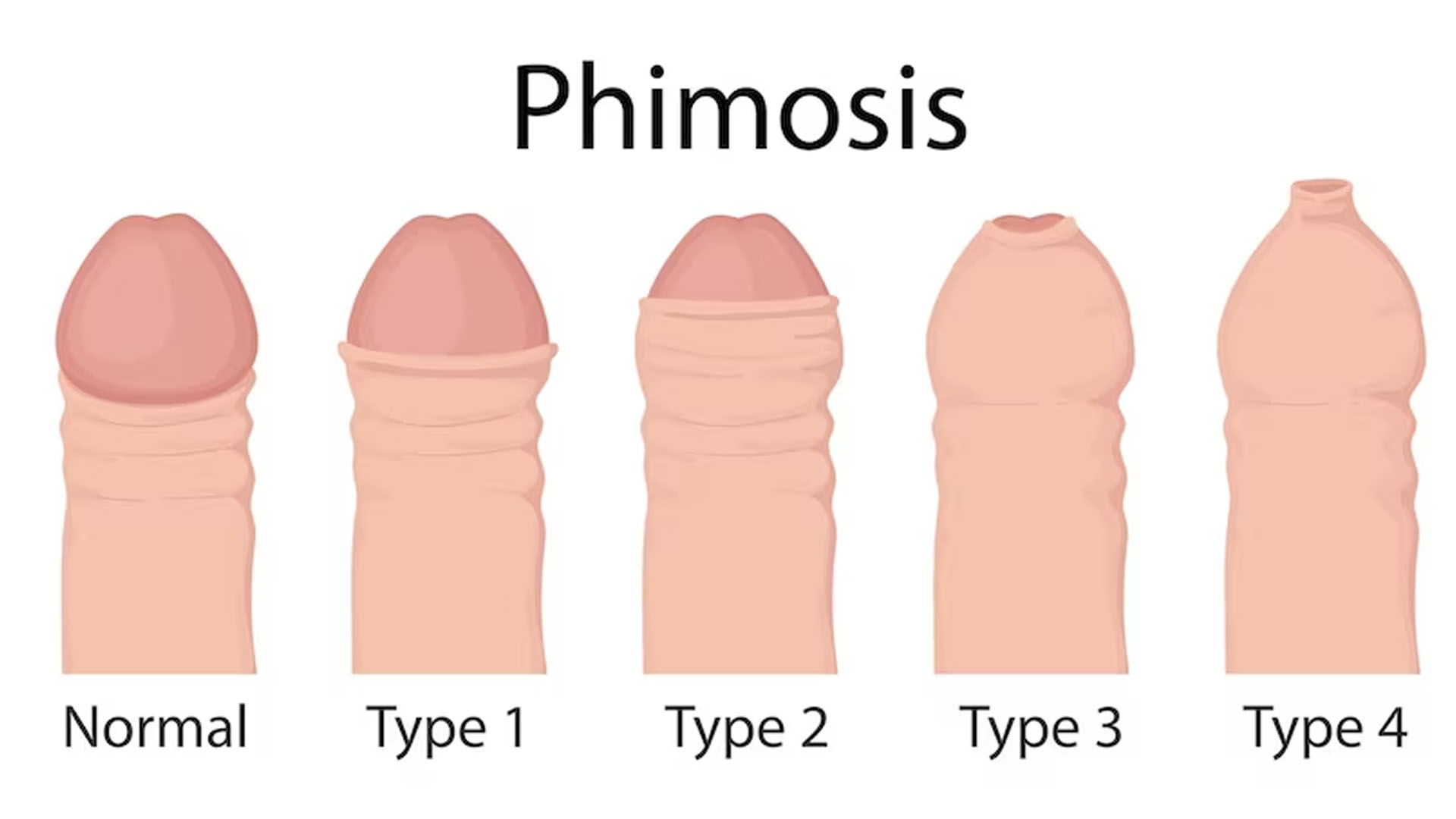 What are the Home Remedies for Phimosis?