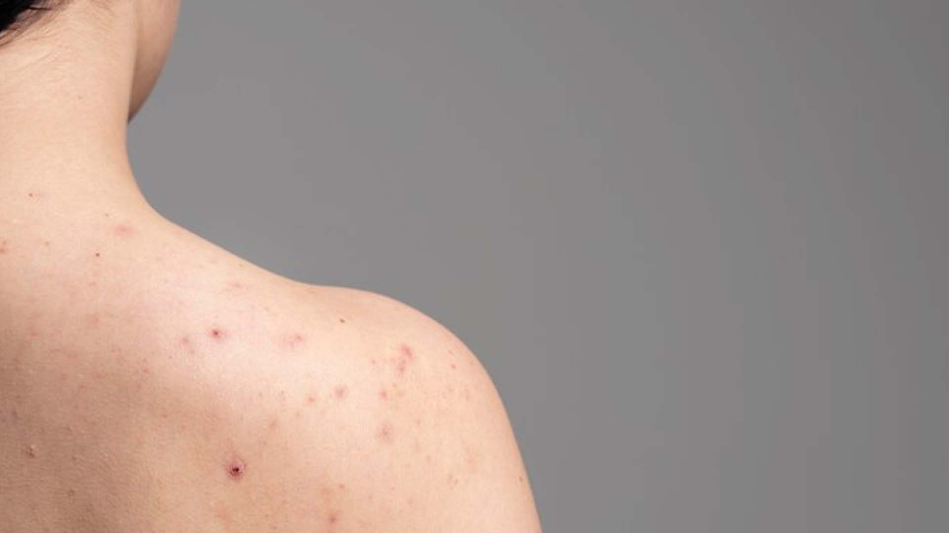 What are the Home Remedies to control Pimples on the Back and Shoulders?