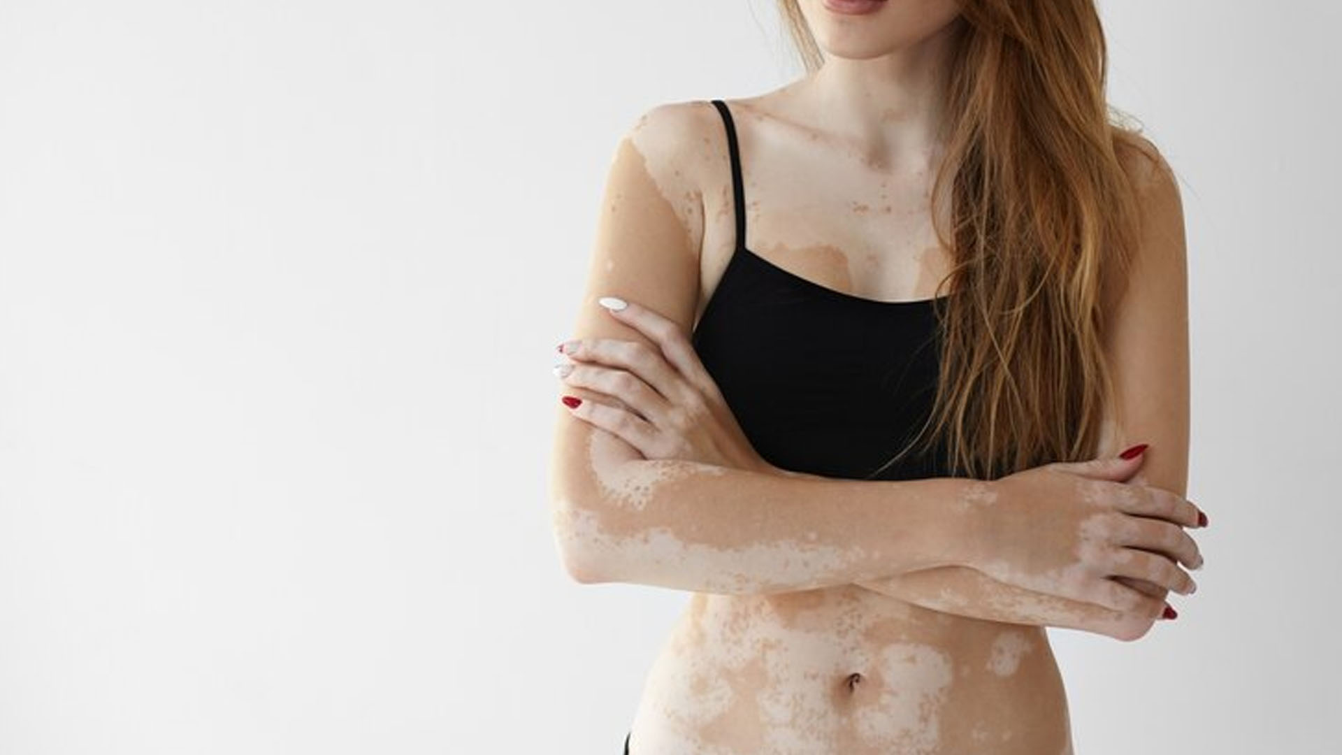 What are the Home Remedies for Pityriasis Alba?