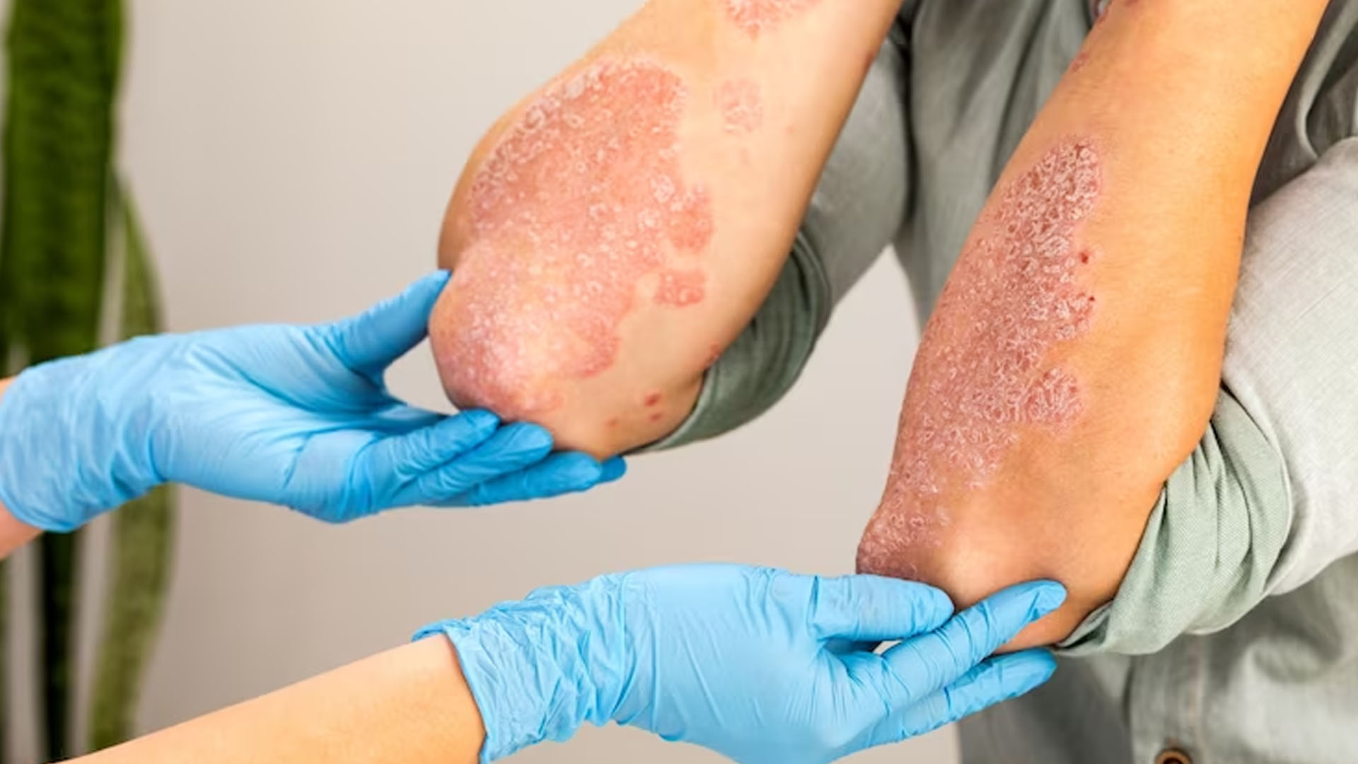 What are the Home Remedies to treat Psoriasis?