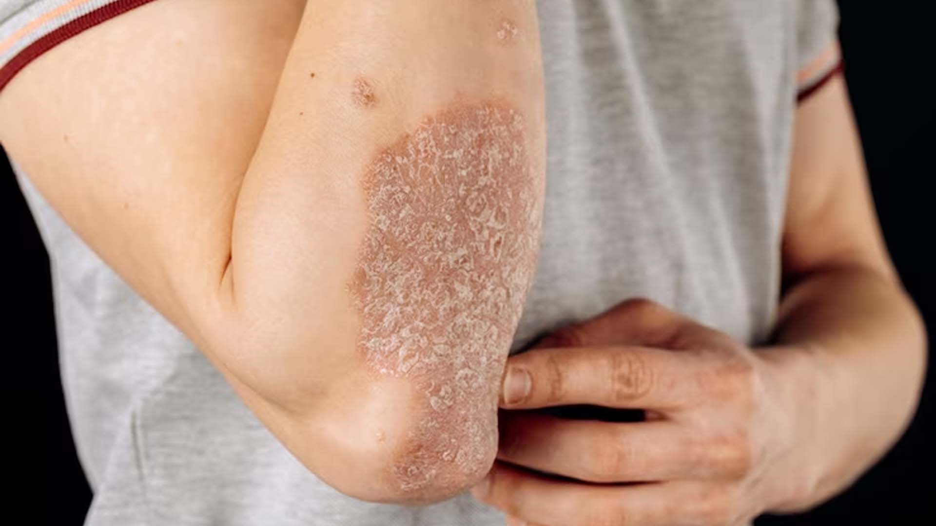 Psoriasis (Autoimmune Disease)