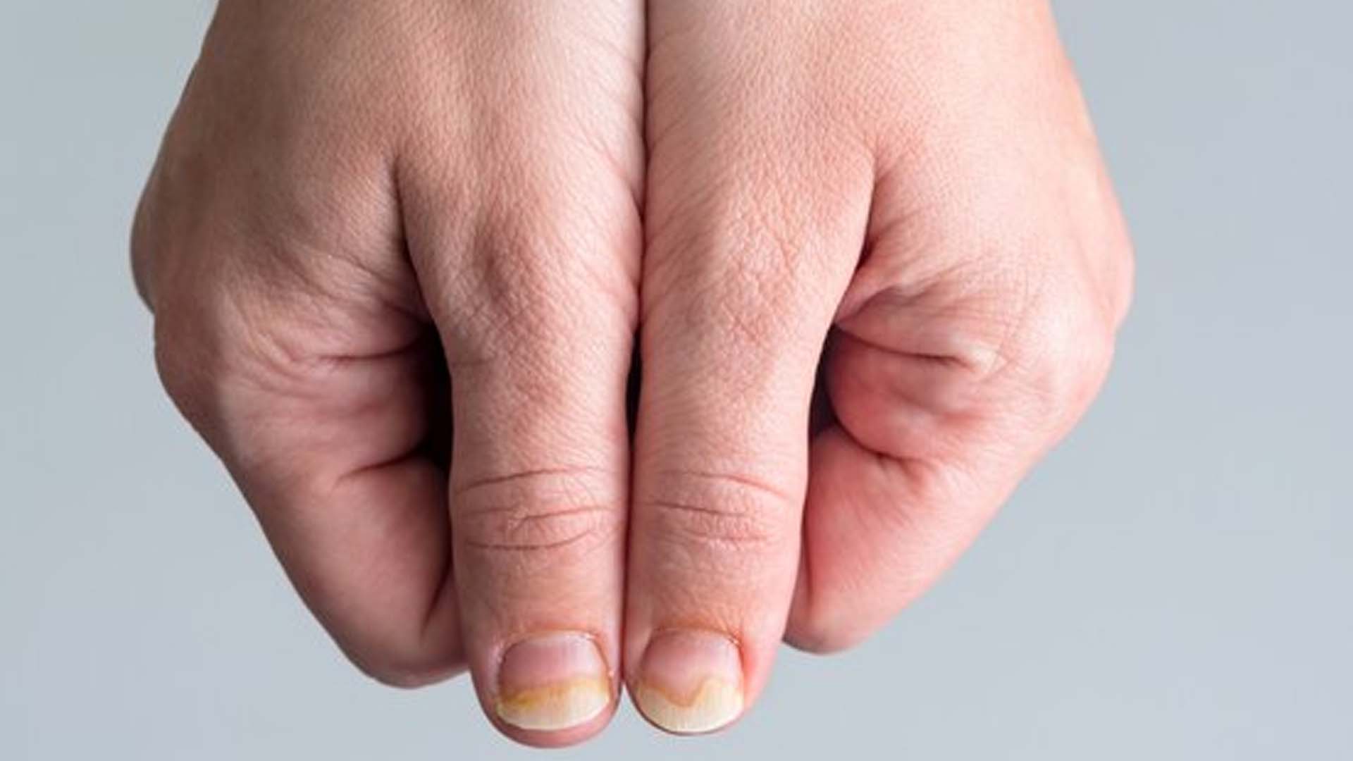 What are the Home Remedies for Pus under the Fingernail?