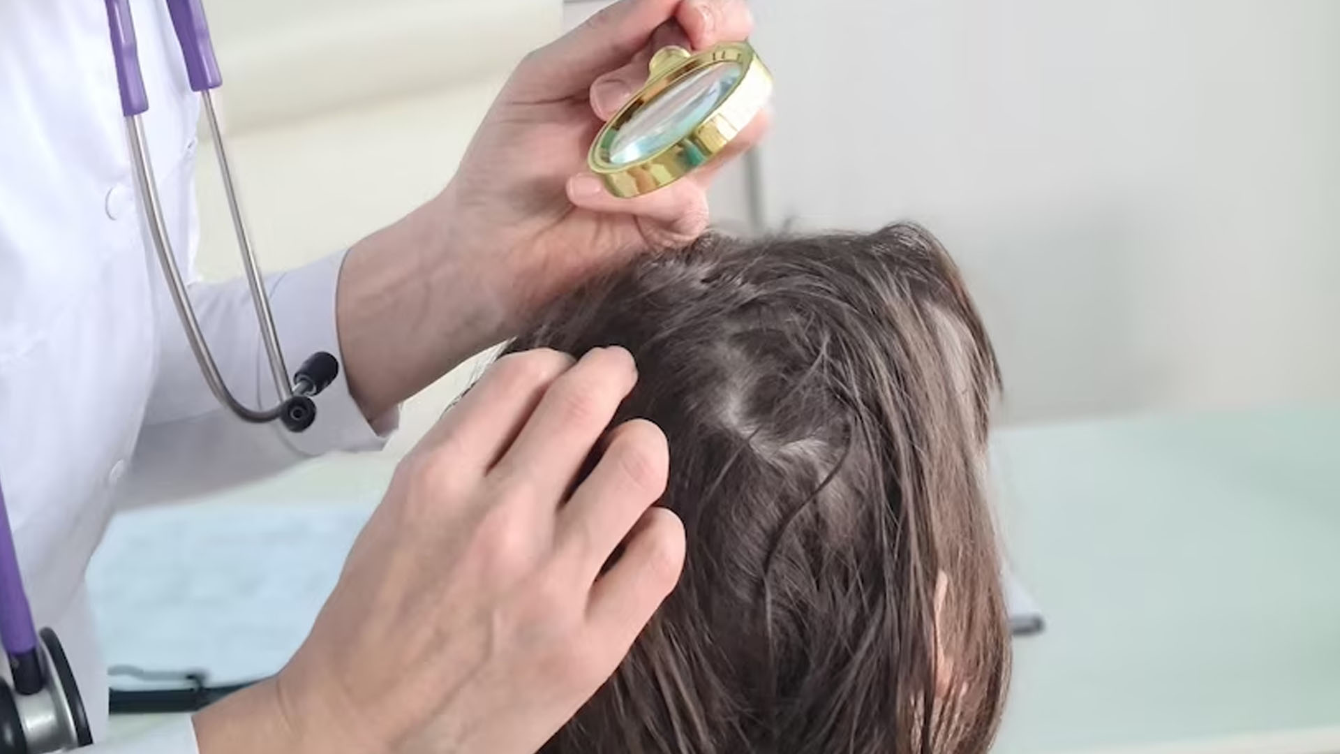 What are the Home Remedies to treat Scalp Fungus?