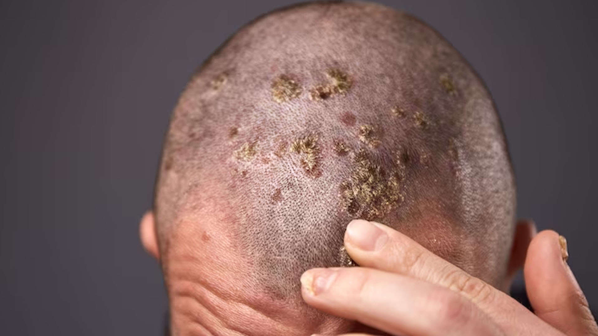 What are the Home Remedies for Scalp Psoriasis?