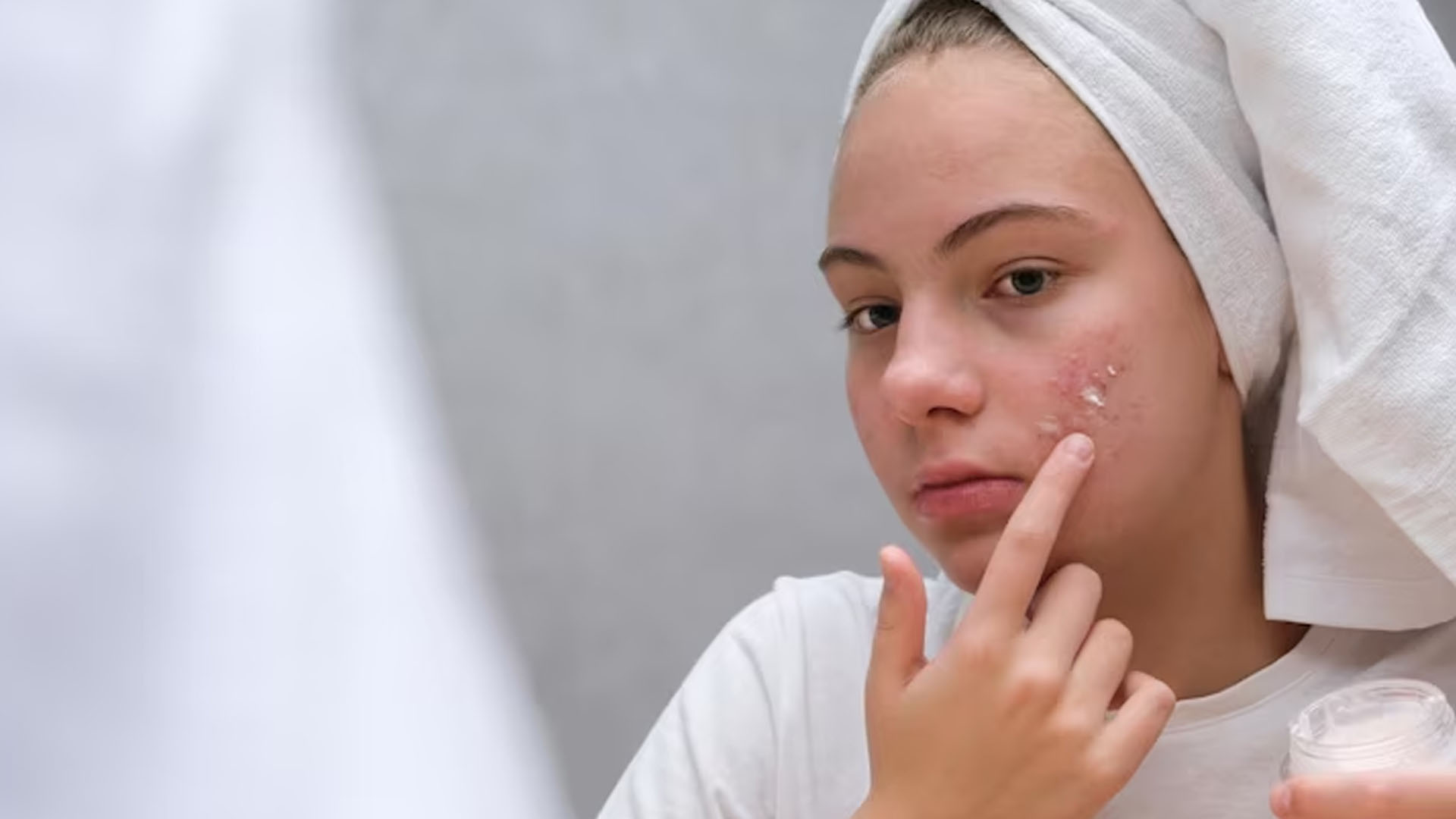 What are the Home Remedies for Seborrheic Dermatitis?