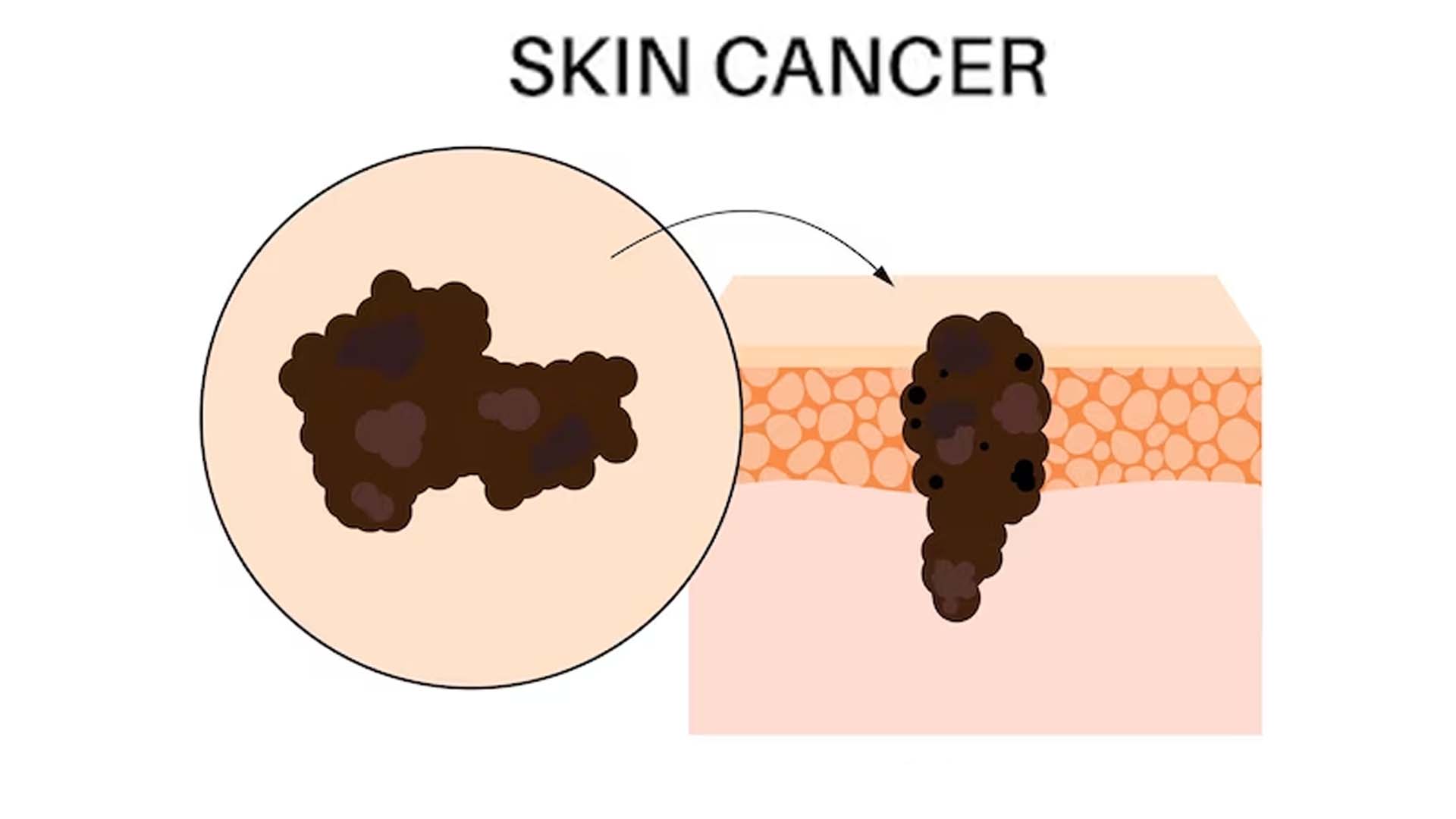 Skin Cancer