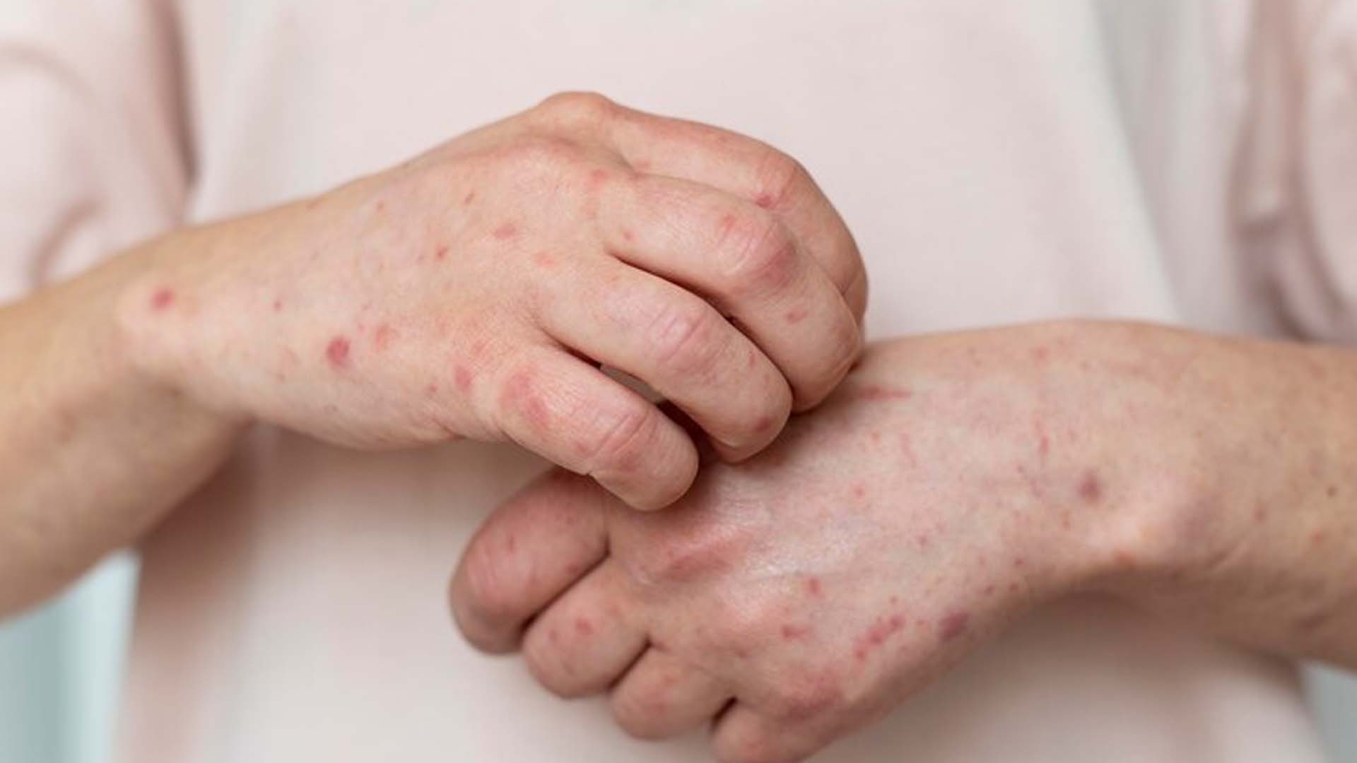Skin Allergies
