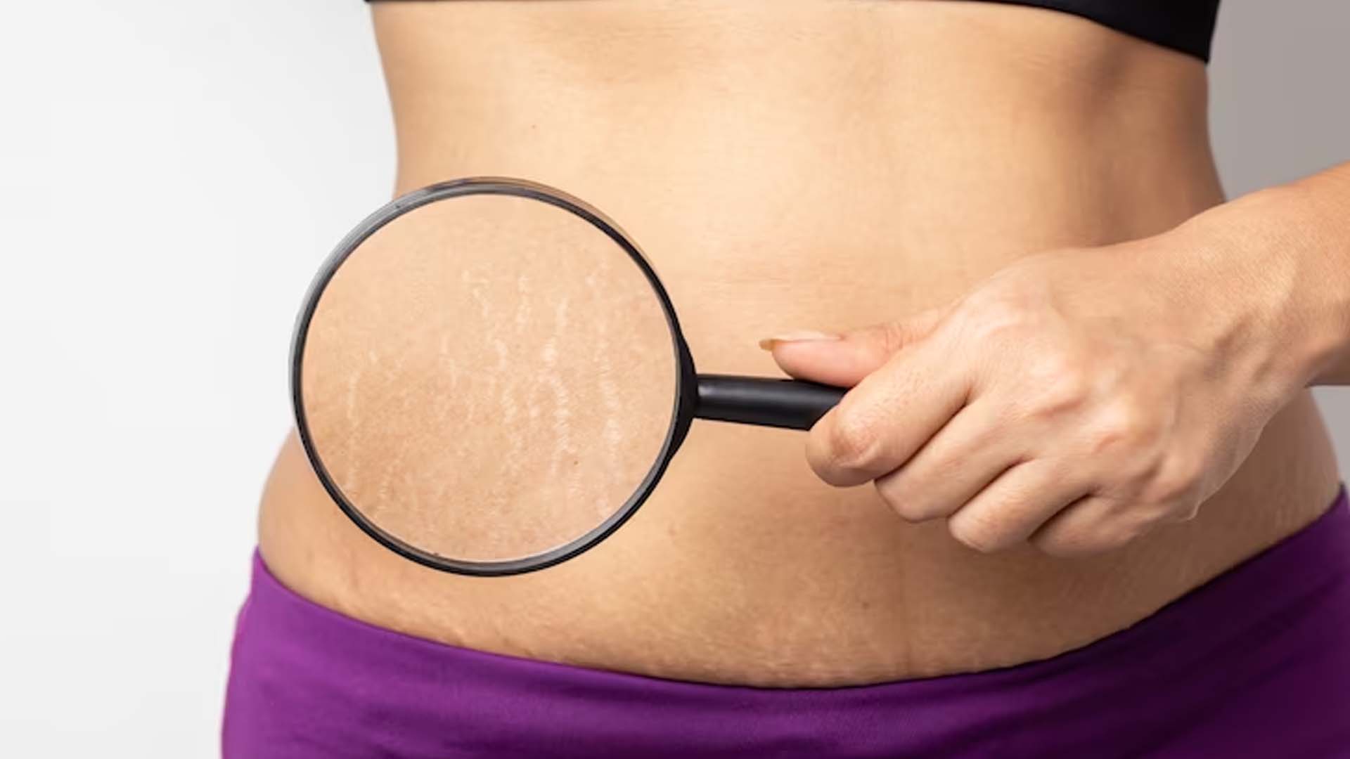 What are the Home Remedies for Stretch Marks?