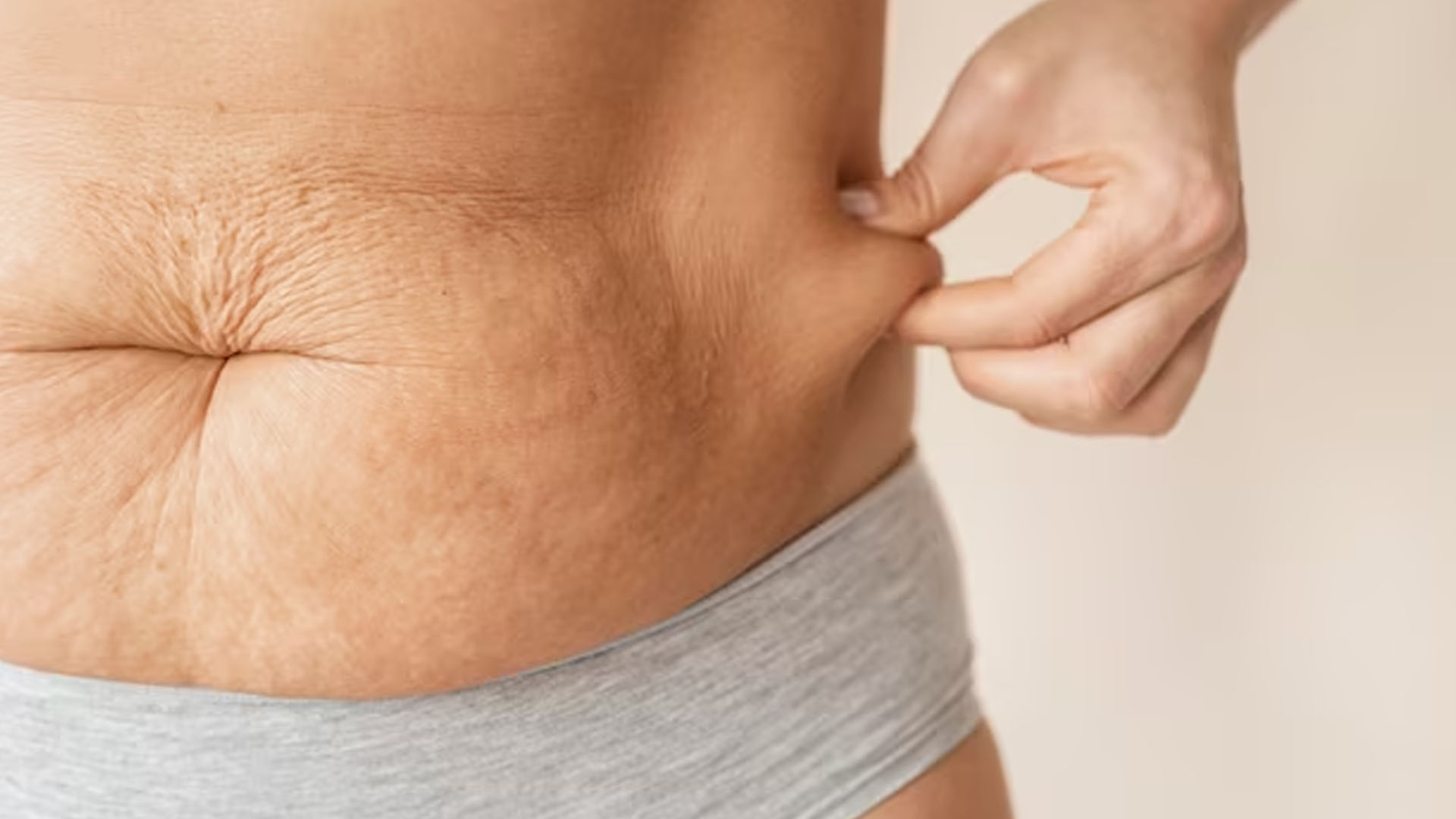 What are the Home Remedies for Stretch Marks?
