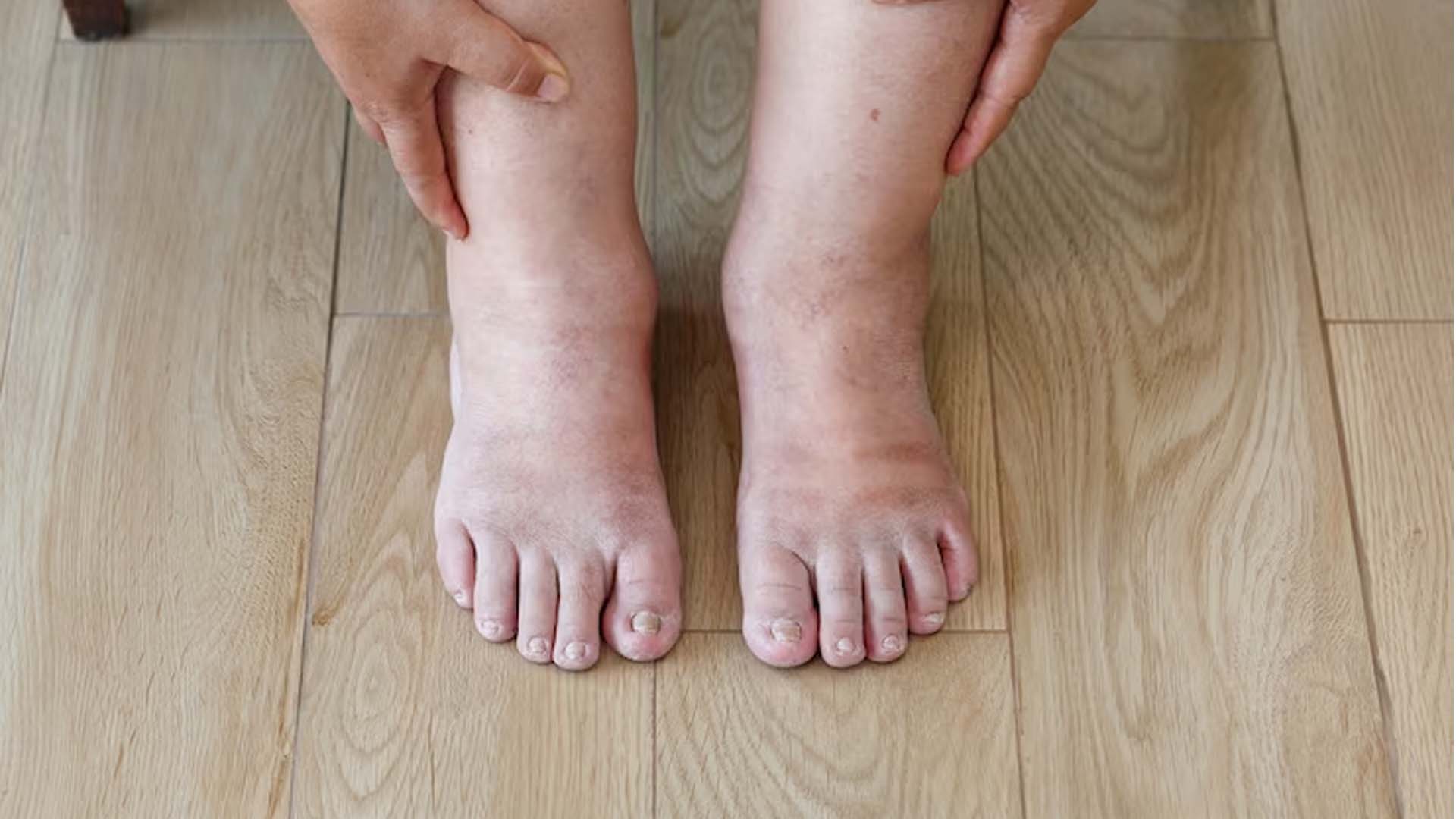 Swelling in feet