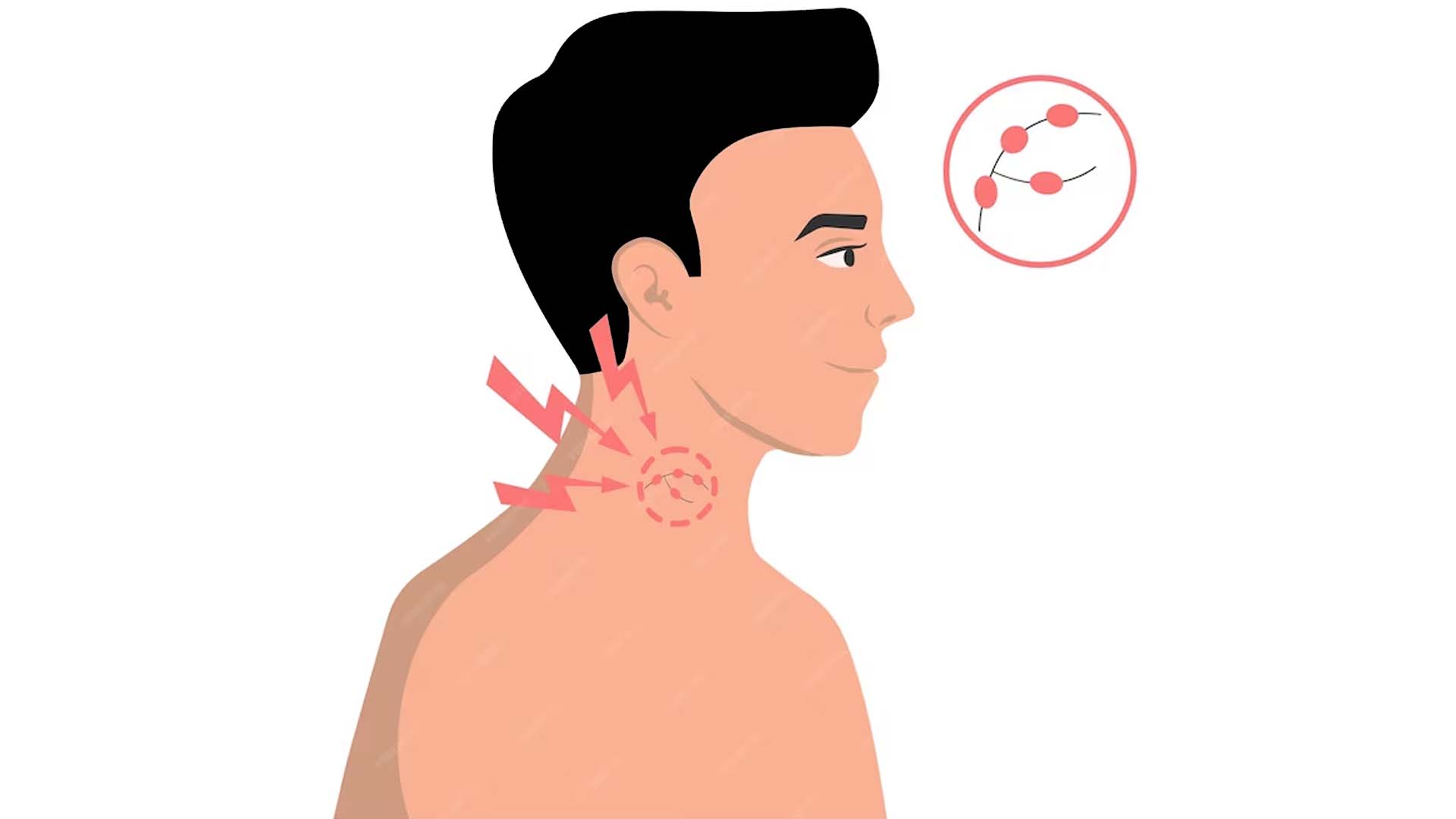 Swelling and pain in the glands (lymph nodes)