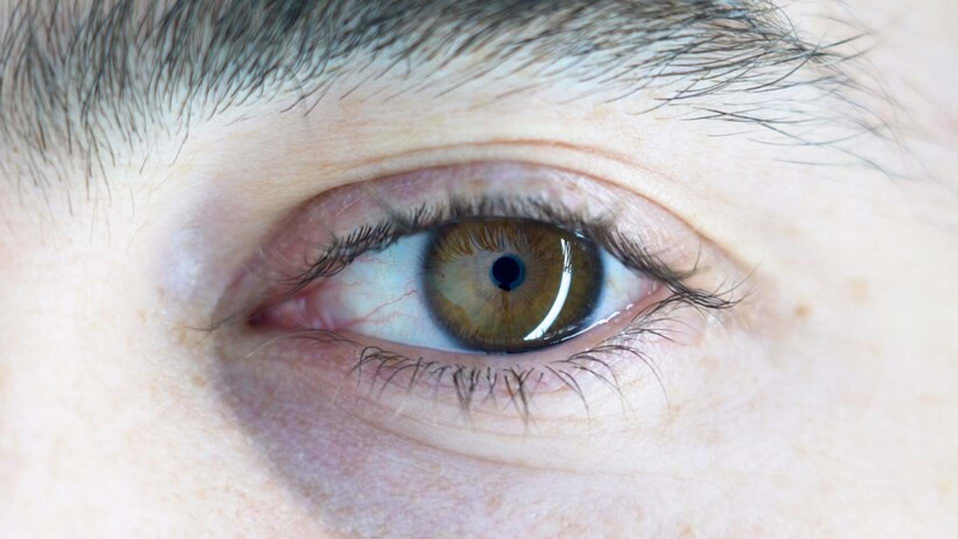 Thin Cornea