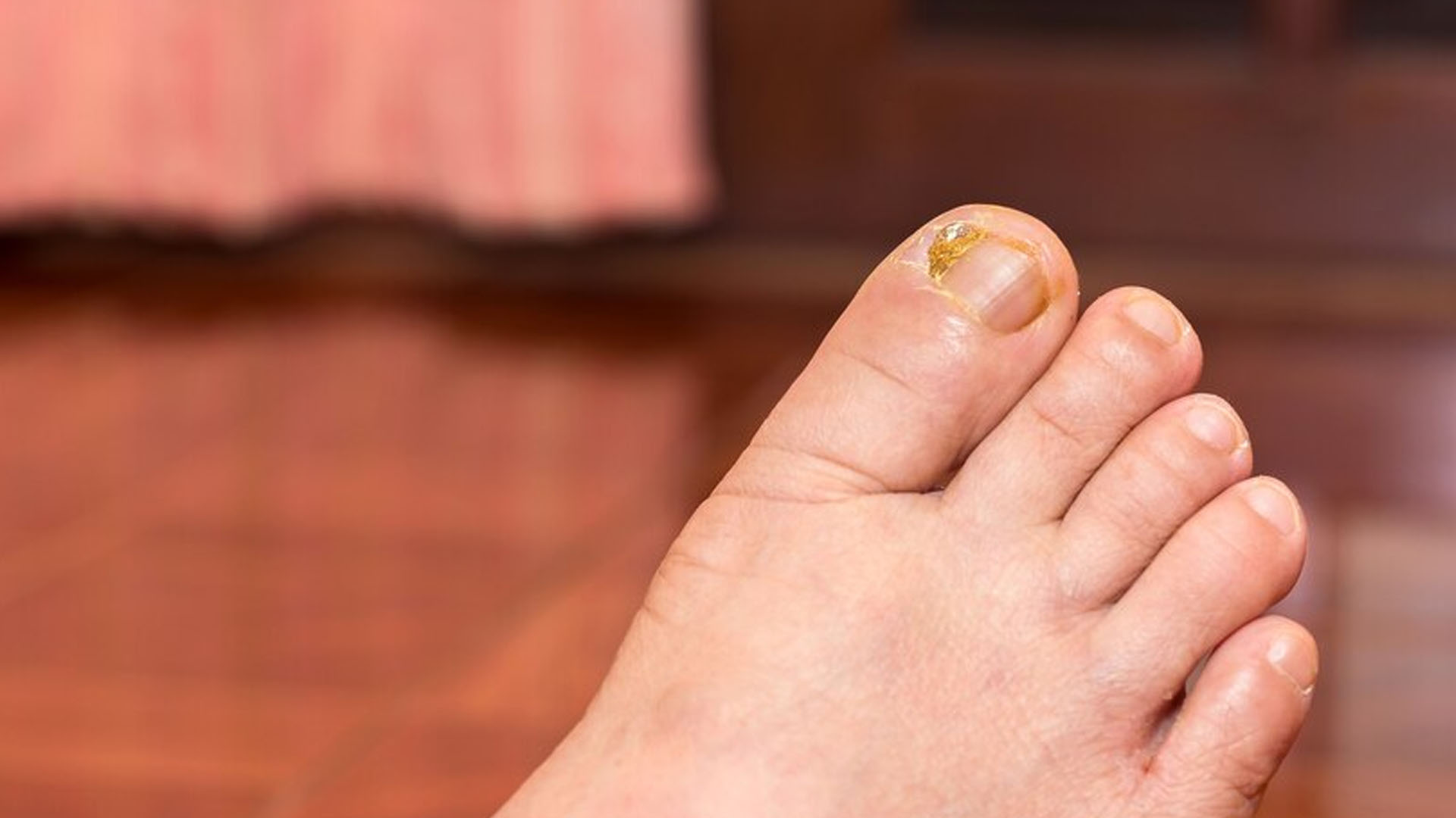 What are the Home Remedies for Toenail Fungus?