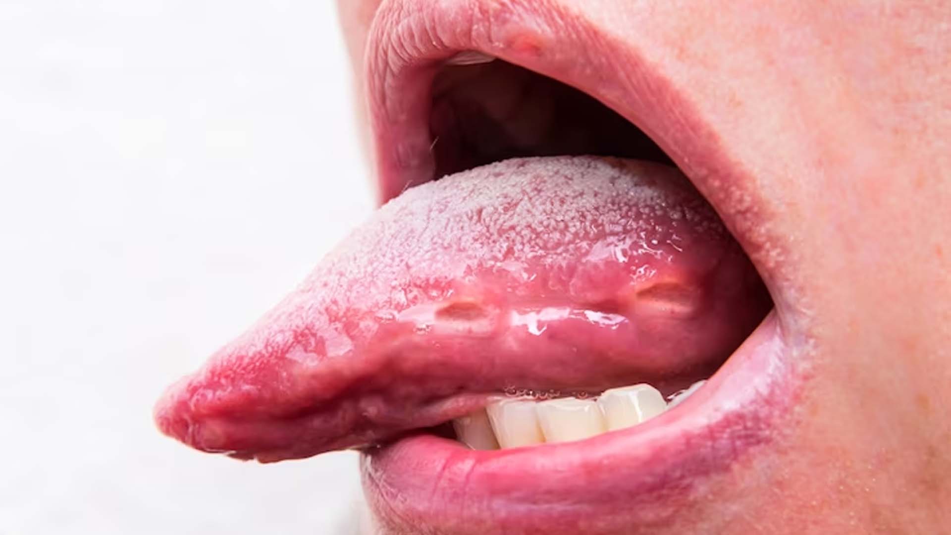 Blisters Under the Tongue