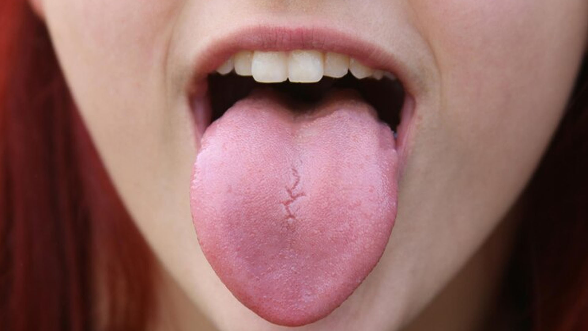 What are the Home Remedies for Tongue Cracks?