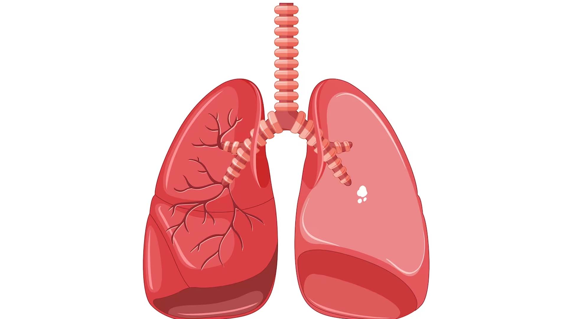 Tuberculosis