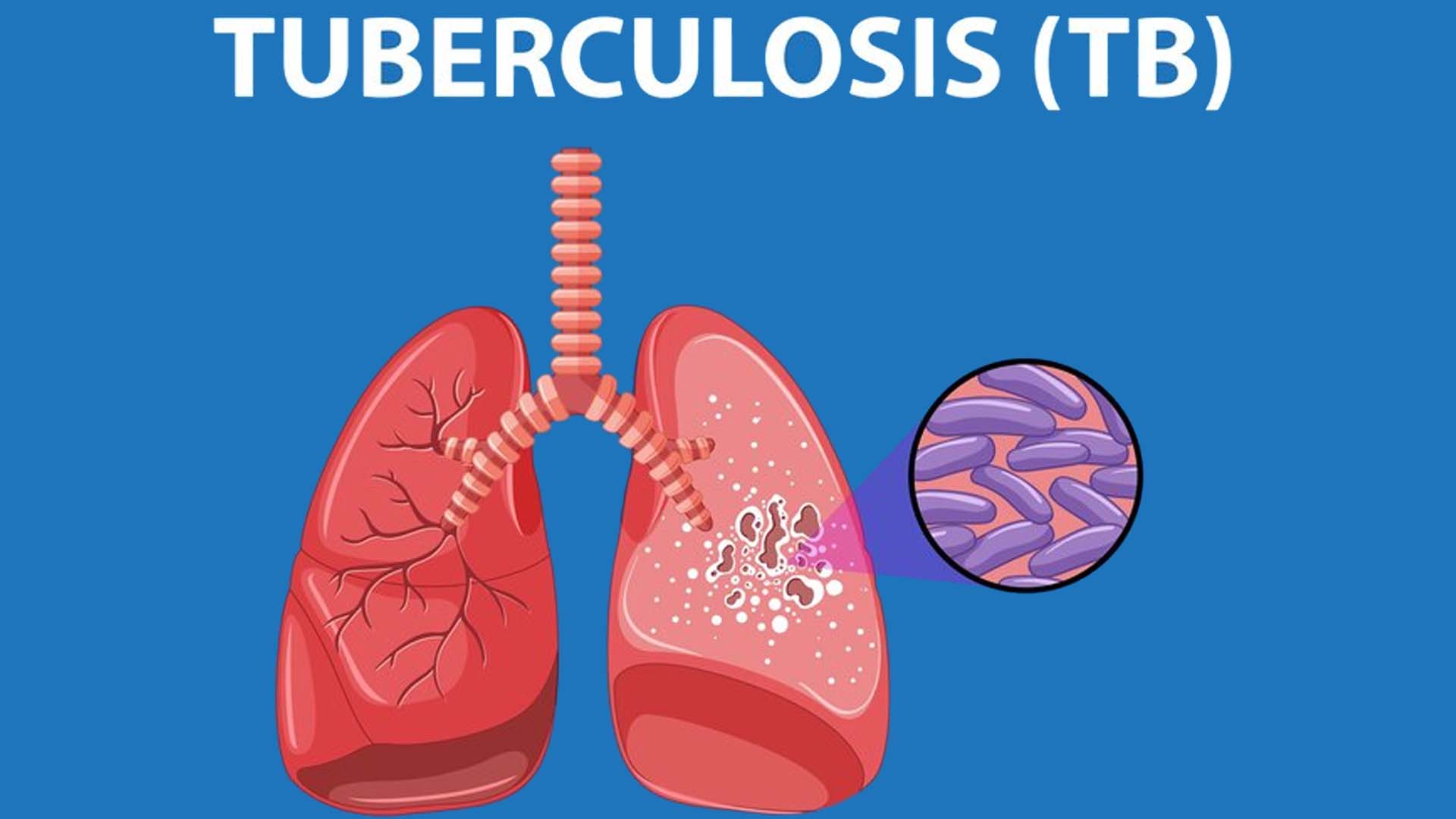 tuberculosis (TB)