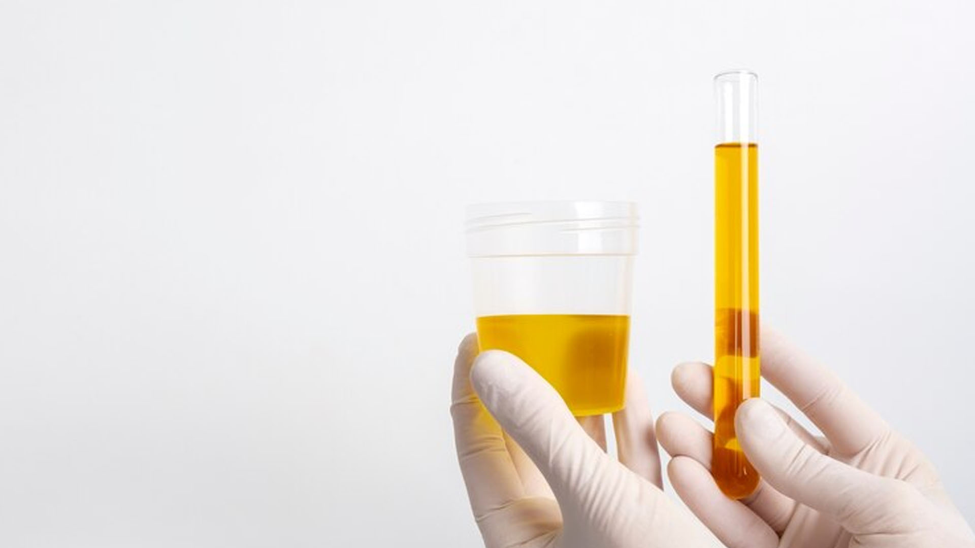 What are the Home Remedies to control Uric Acid Levels?