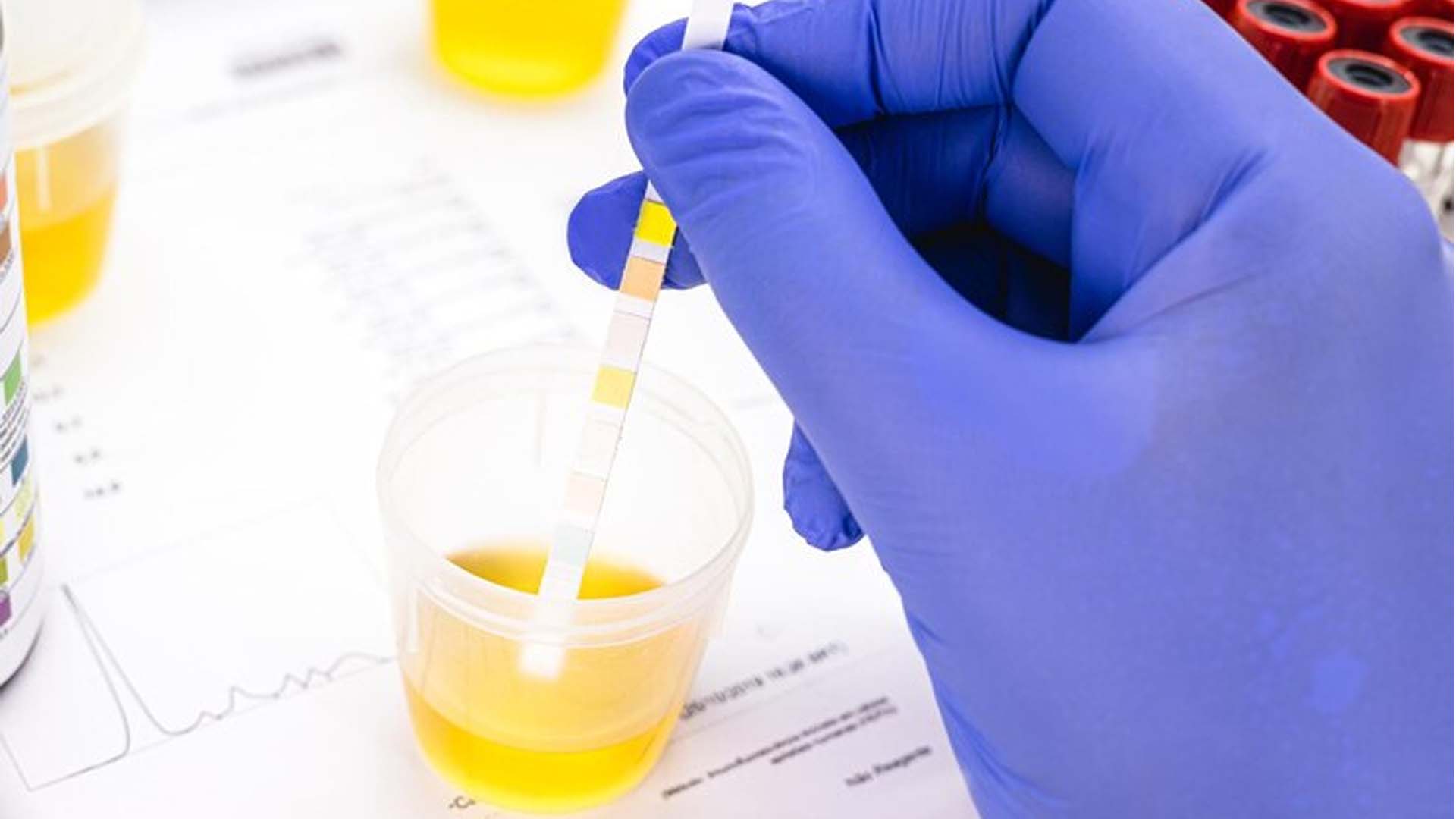 Urine sample test