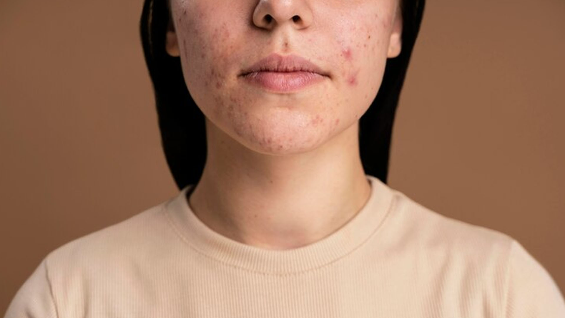 What are the Home Remedies for Warts on Face?