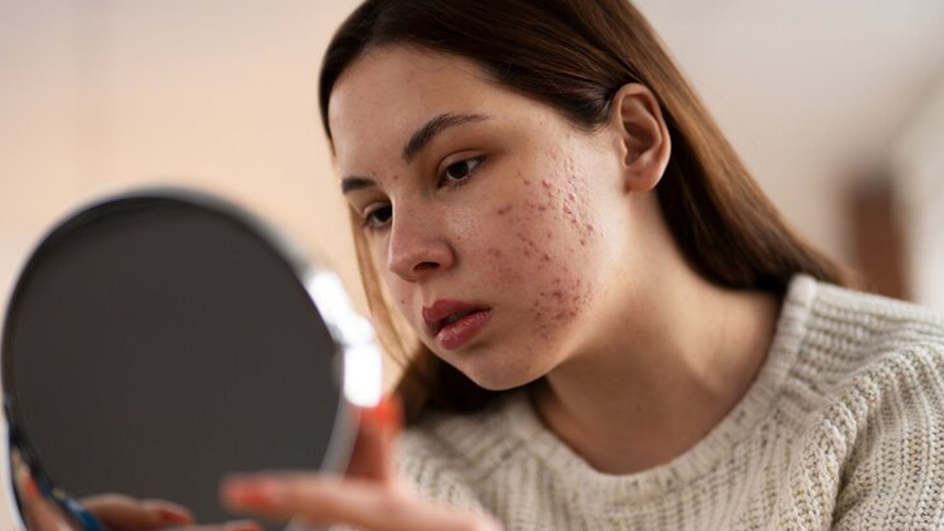 What are the Home Remedies for Acne Spots?