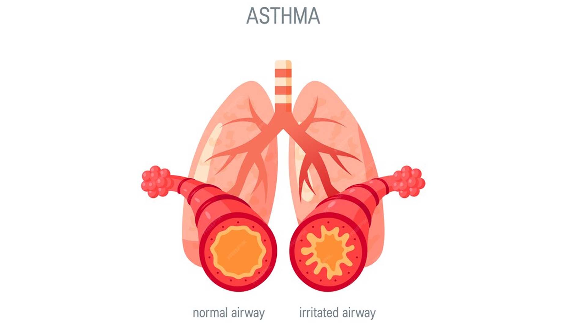 Asthma