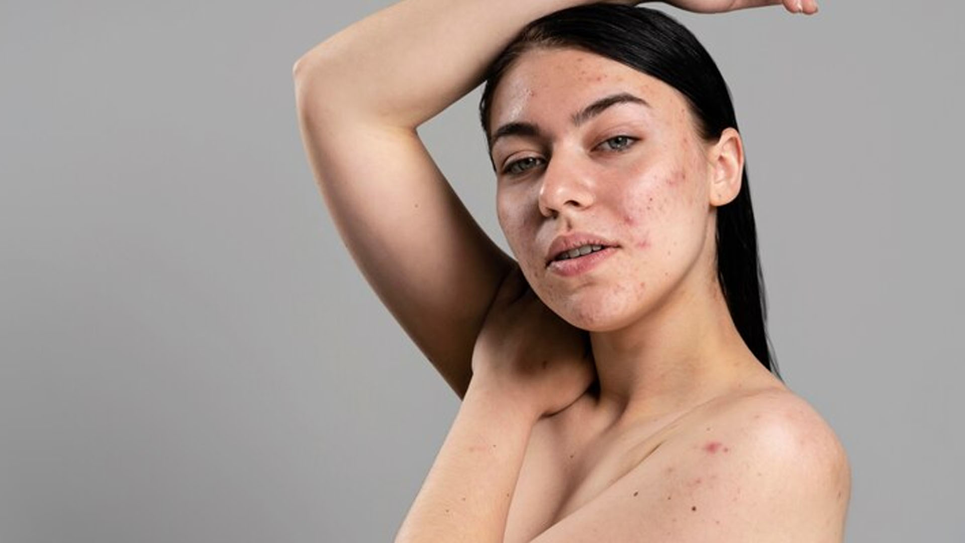 What are the Home Remedies for Body Acne?