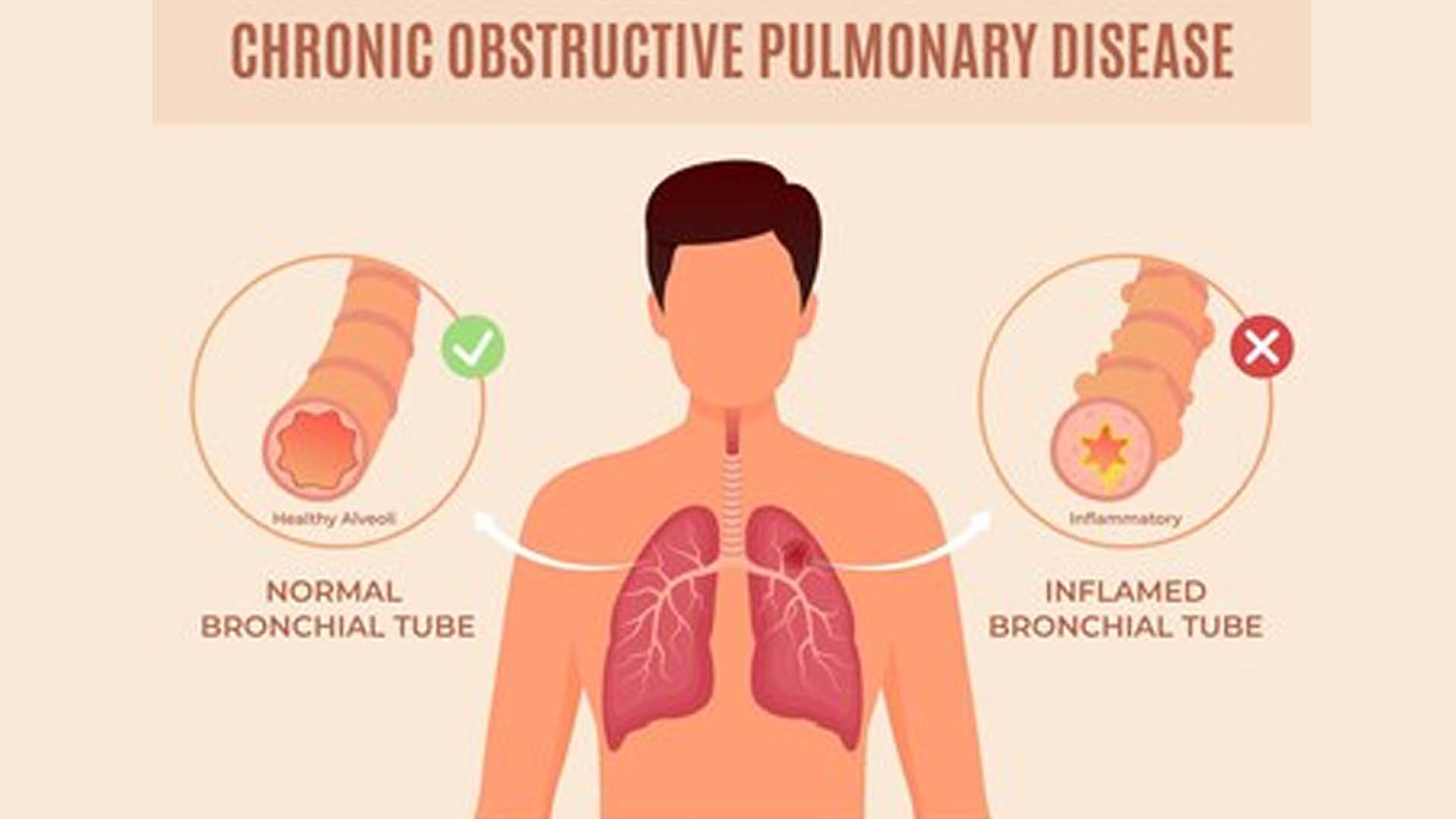 Chronic Obstructive Pulmonary Disease (COPD)