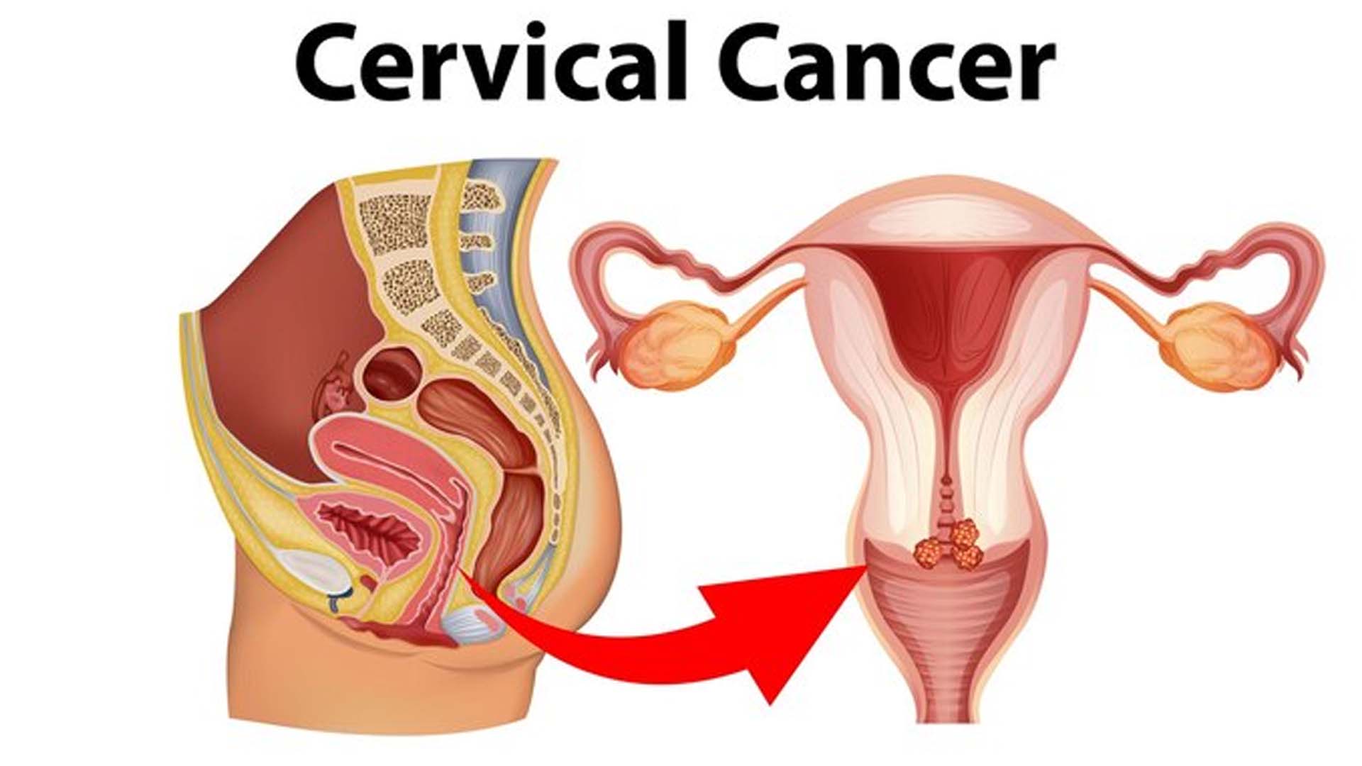 Cervical Cancer