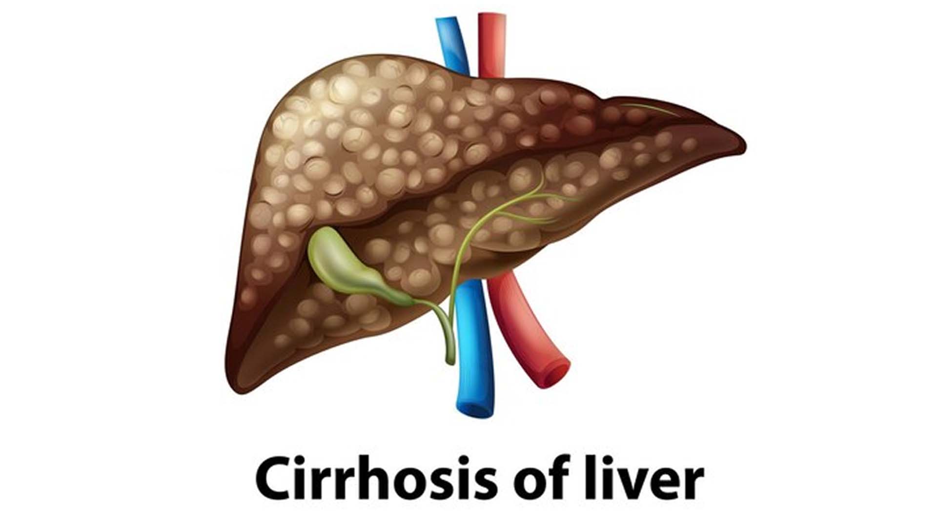Cirrhosis of Liver