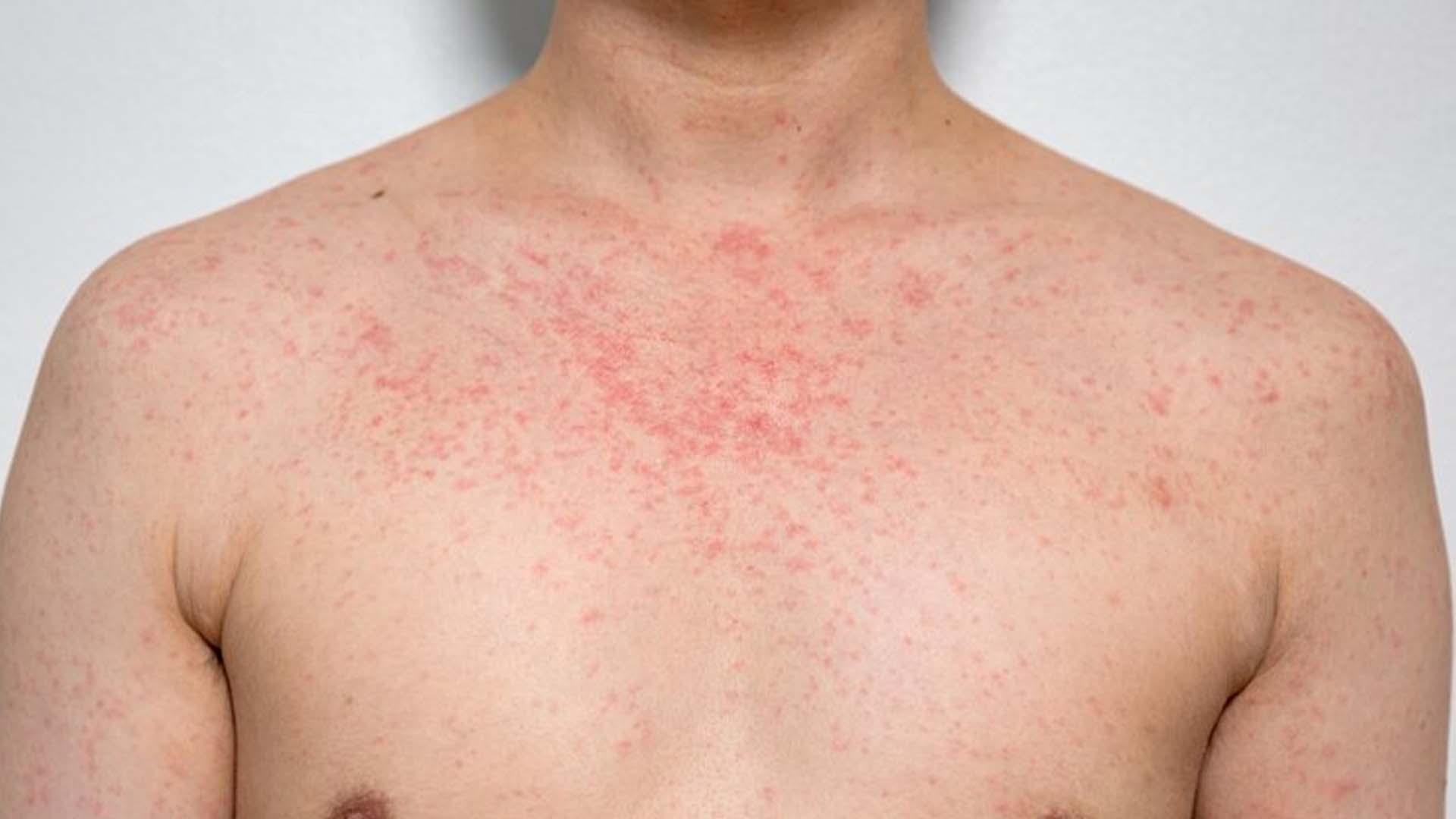 Dermatitis