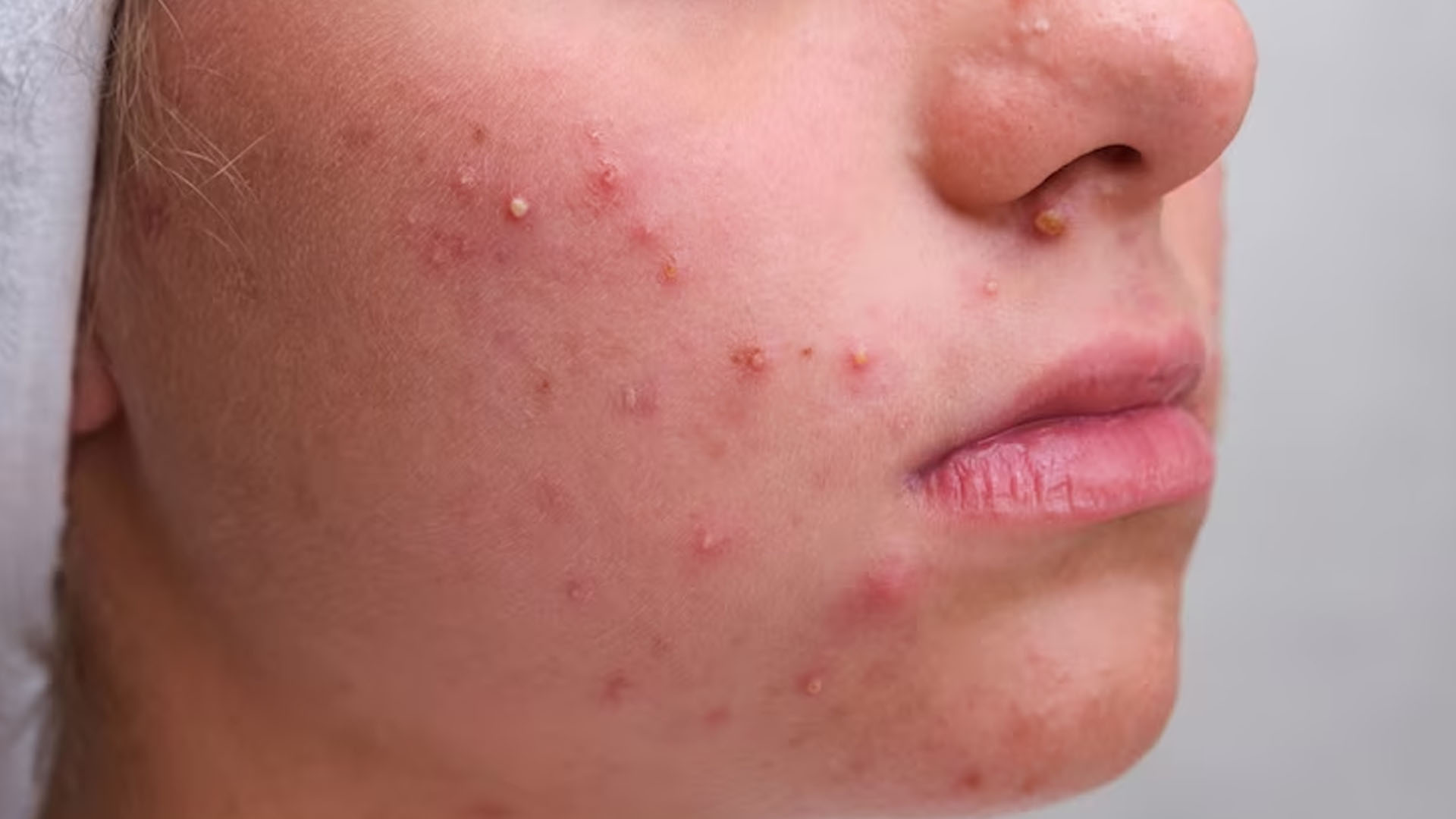 What are the Home Remedies for Fungal Acne?
