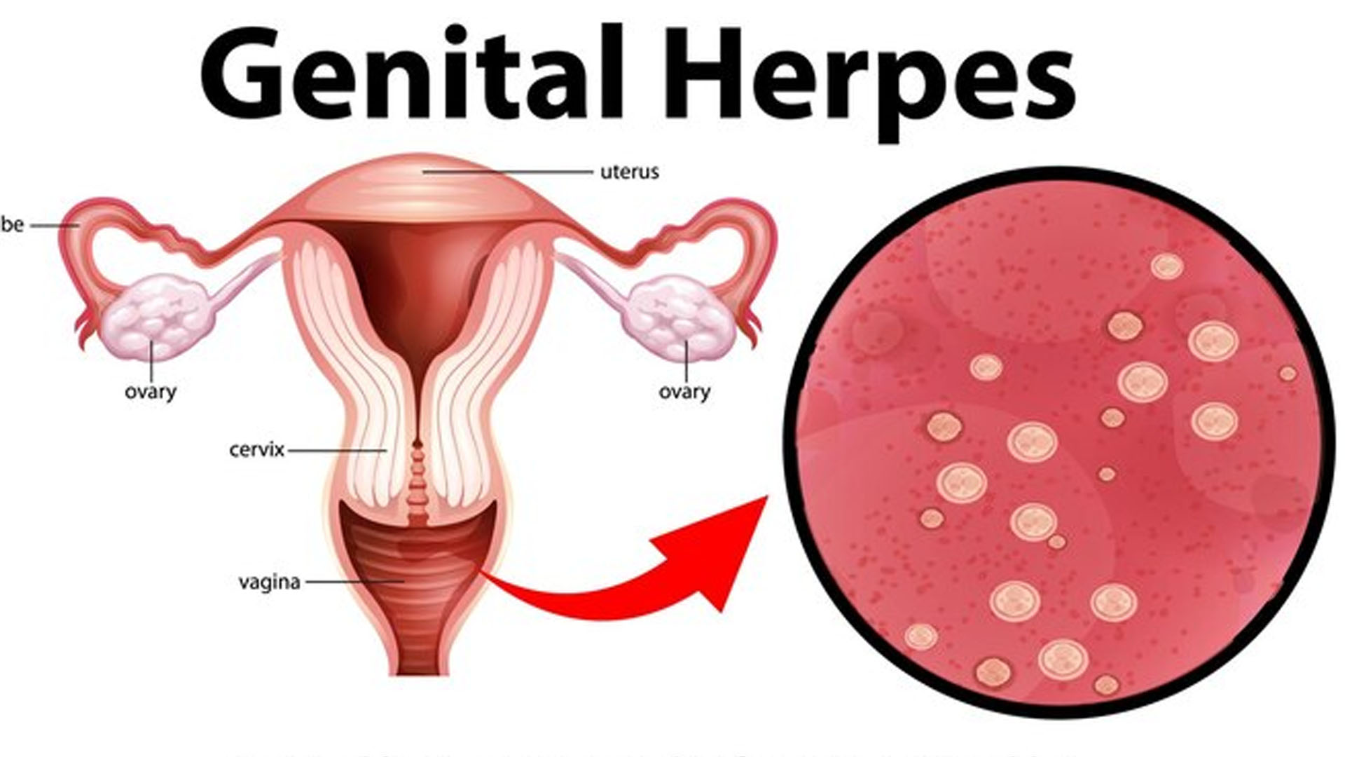 What are the Home Remedies for Genital Herpes?