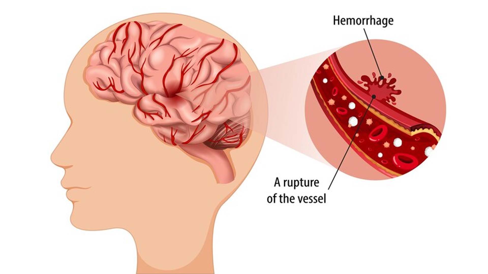 Hemorrhagic Shock