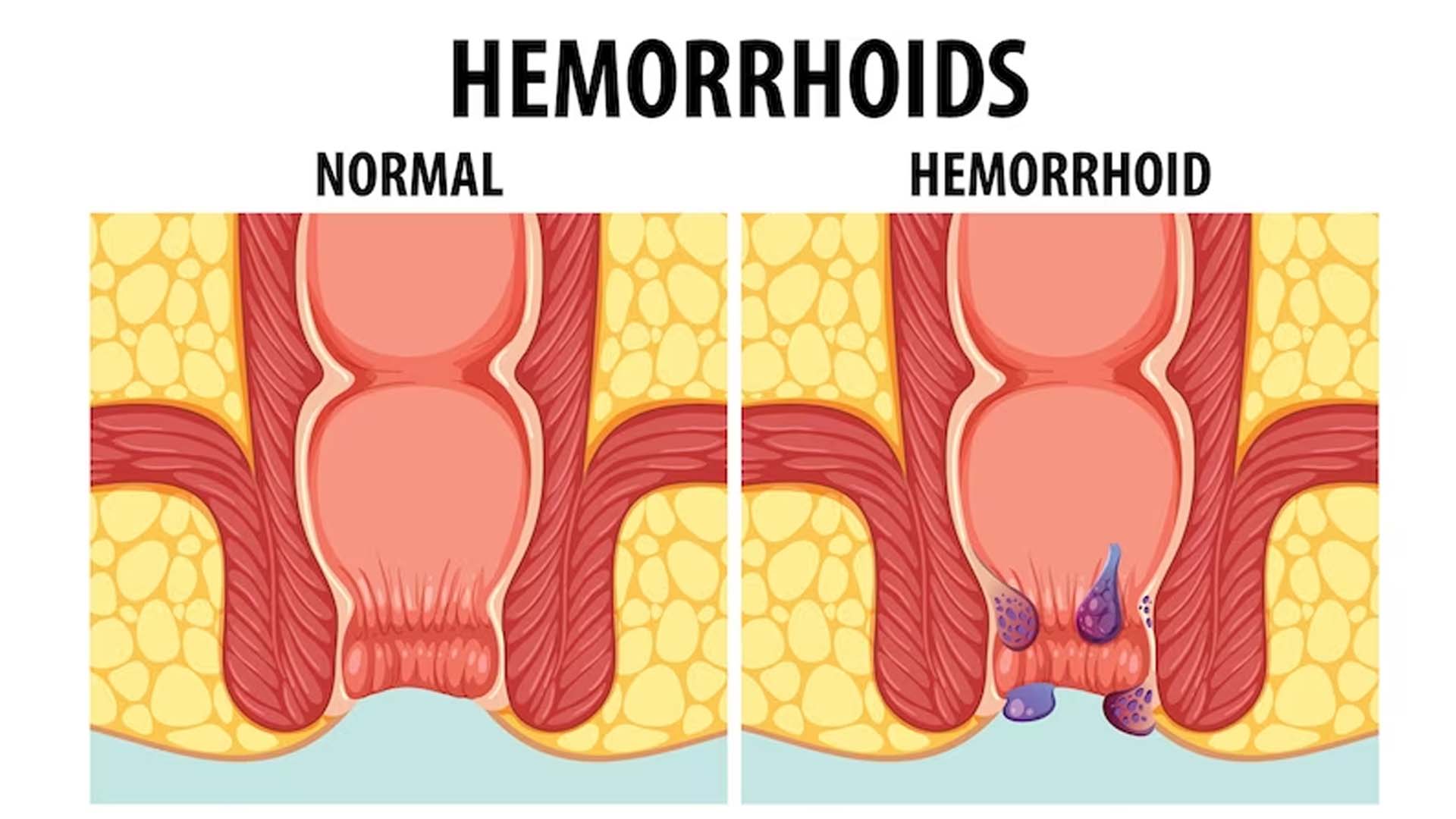 Hemorrhoids