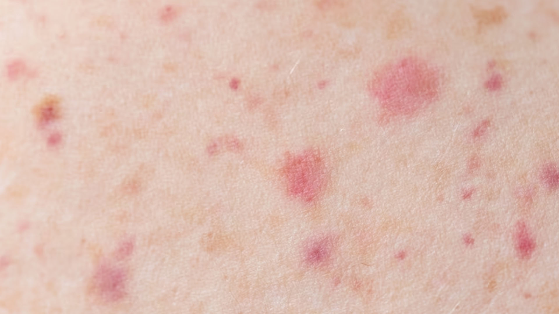 What are the Home Remedies for Herpes Zoster?